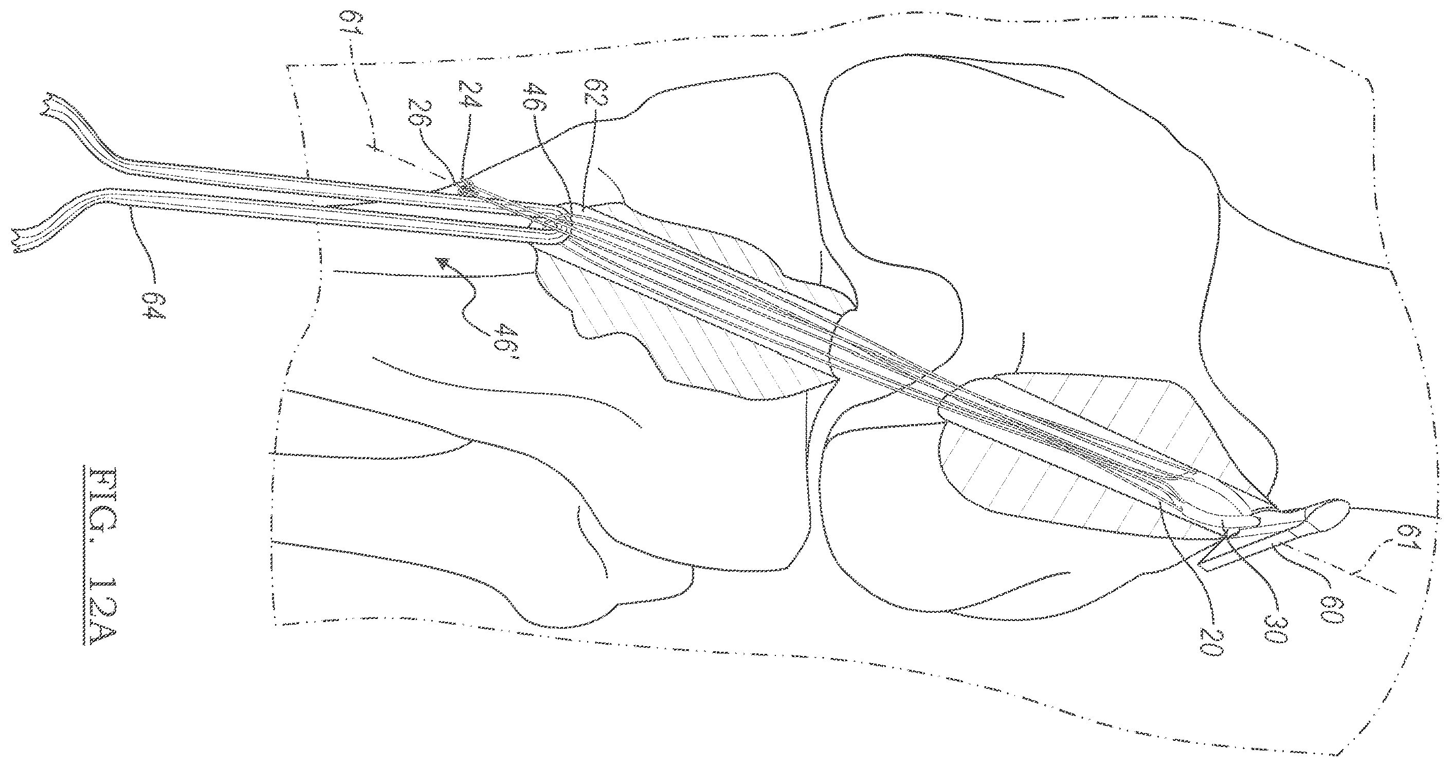 Patent US12551209 Figure 6 – Method and apparatus for coupling soft tissue to a bone