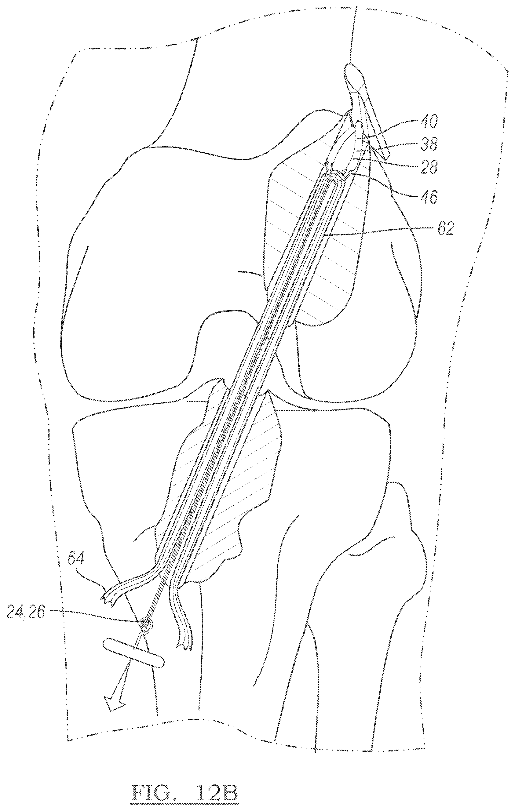 Patent US12551209 Figure 7 – Method and apparatus for coupling soft tissue to a bone