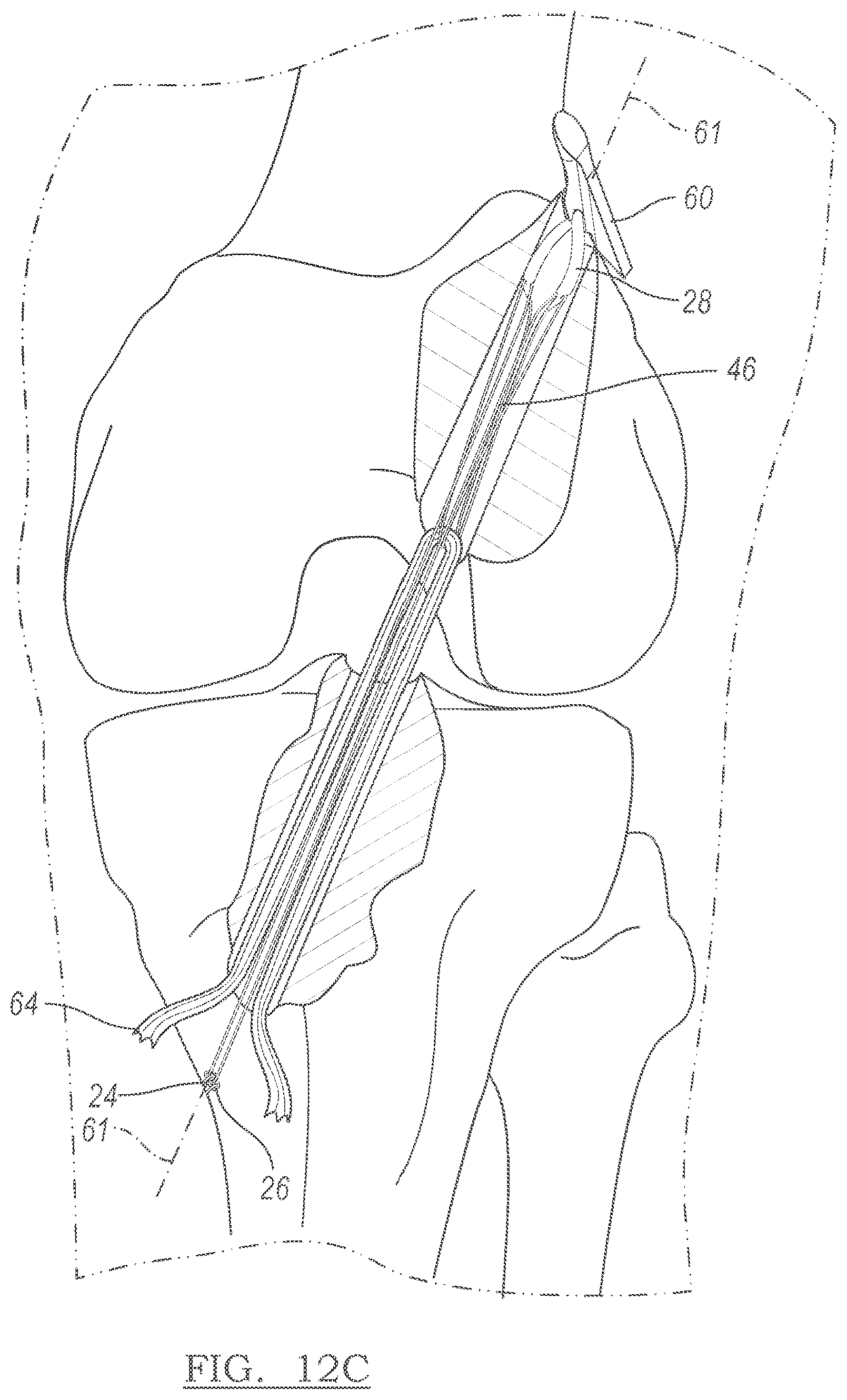 Patent US12551209 Figure 8 – Method and apparatus for coupling soft tissue to a bone