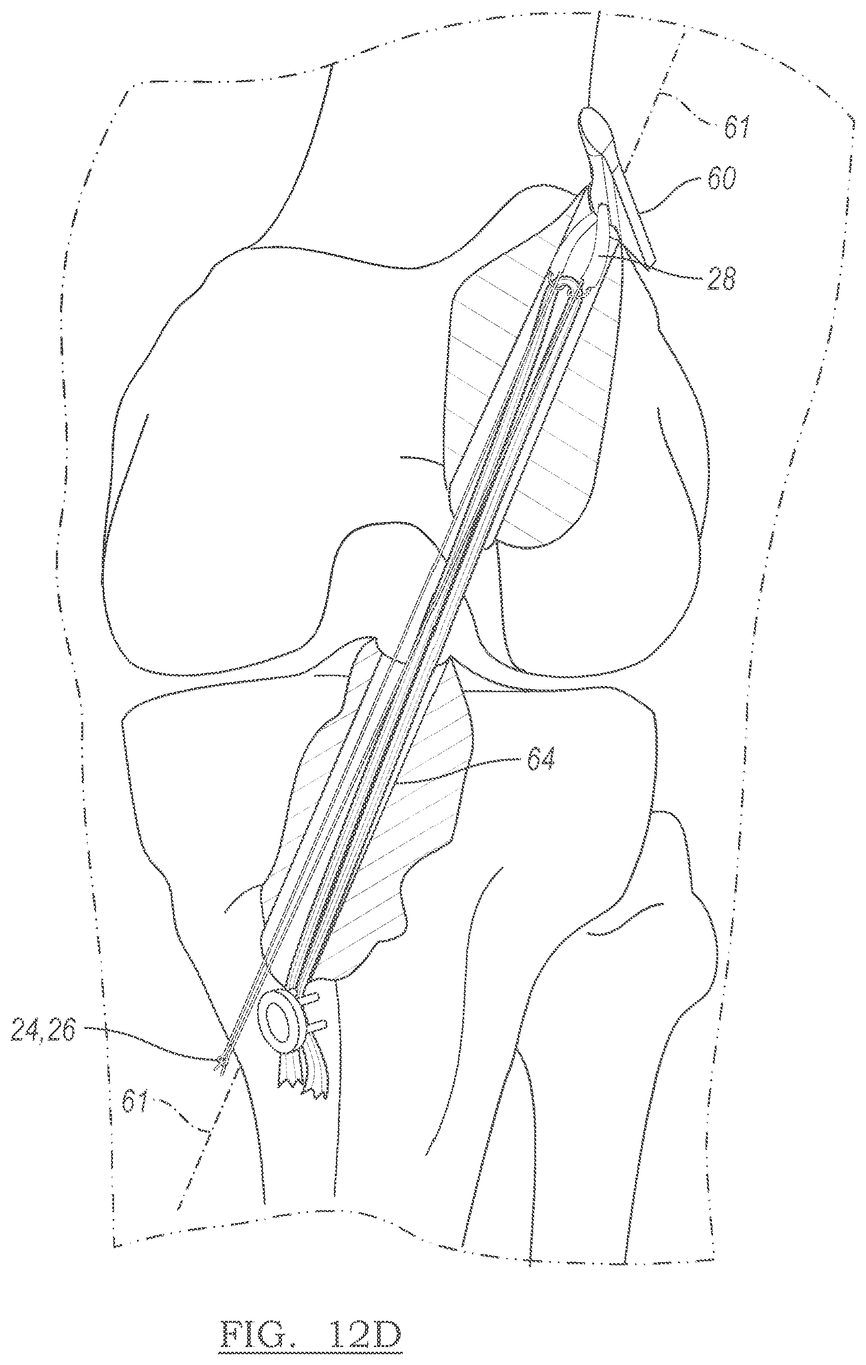 Patent US12551209 Figure 9 – Method and apparatus for coupling soft tissue to a bone