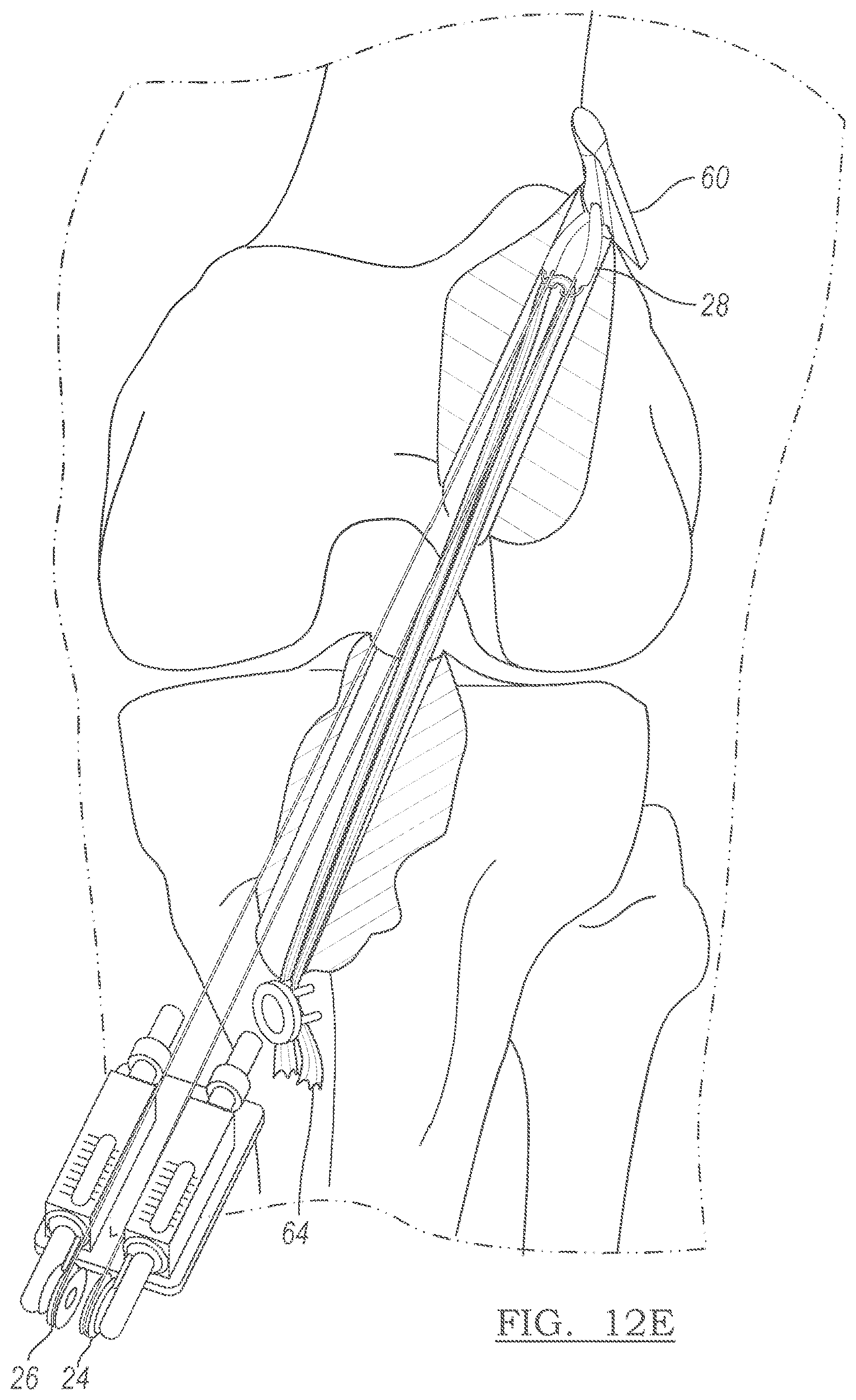 Patent US12551209 Figure 10 – Method and apparatus for coupling soft tissue to a bone