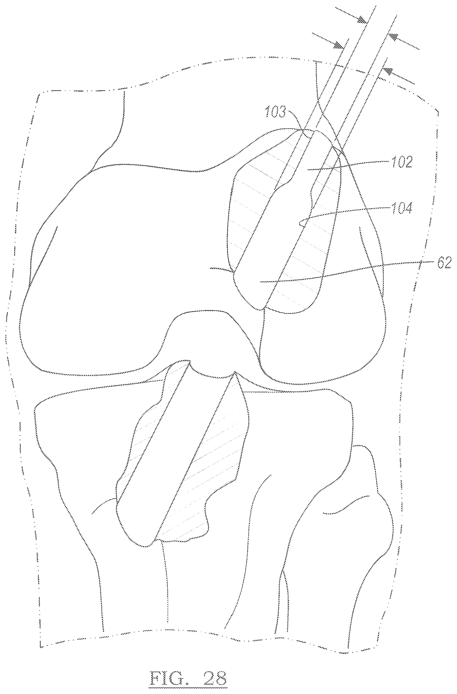 Patent US12551209 Figure 16 – Method and apparatus for coupling soft tissue to a bone