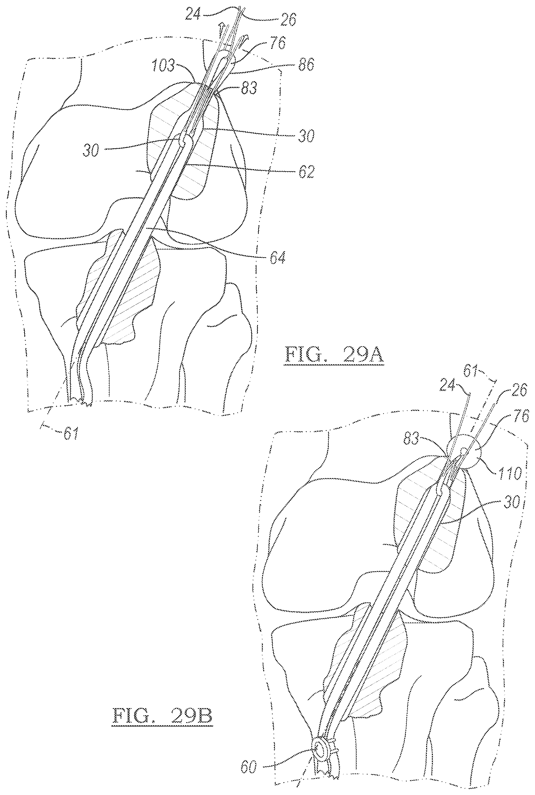 Patent US12551209 Figure 17 – Method and apparatus for coupling soft tissue to a bone
