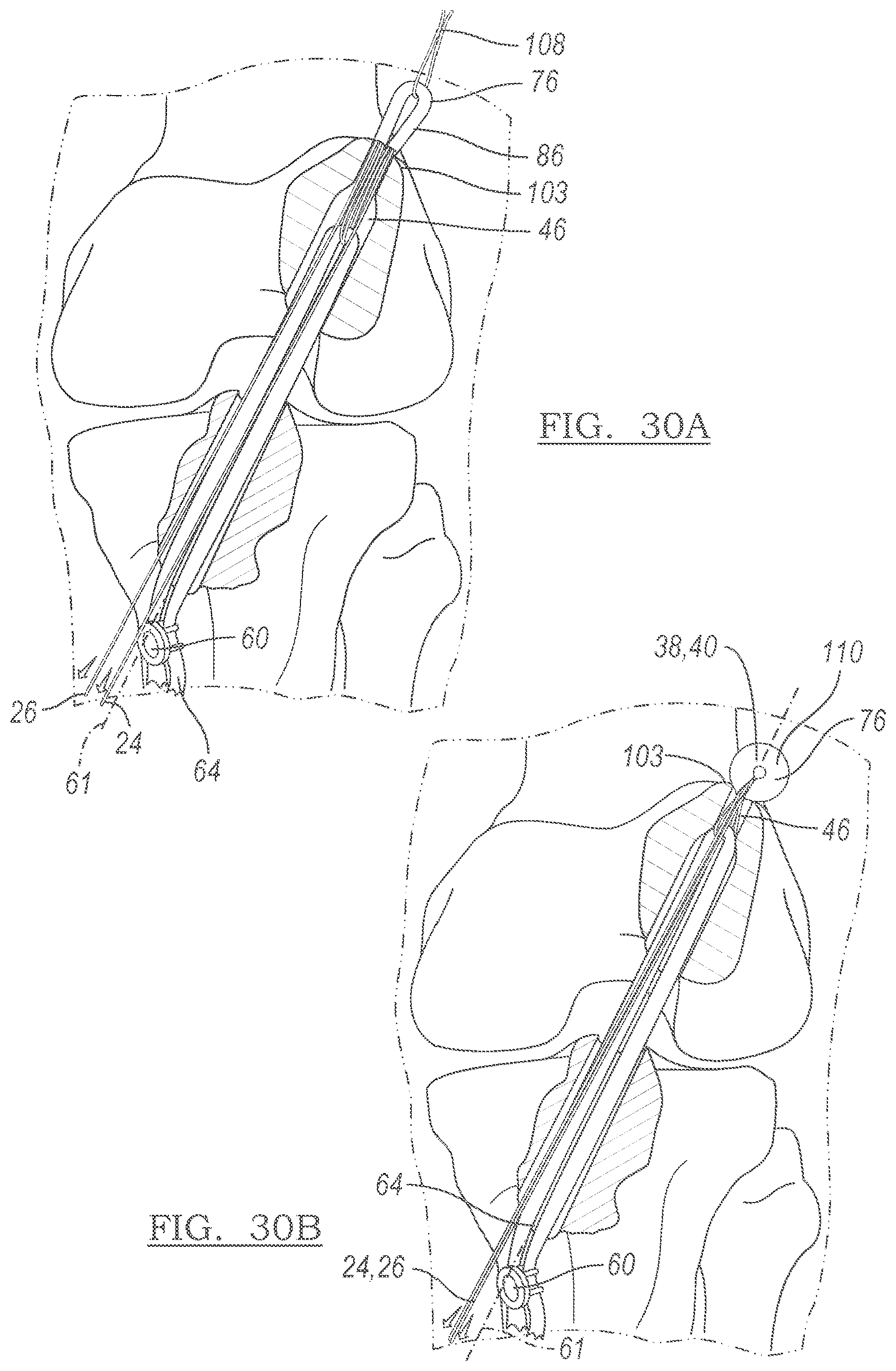 Patent US12551209 Figure 18 – Method and apparatus for coupling soft tissue to a bone