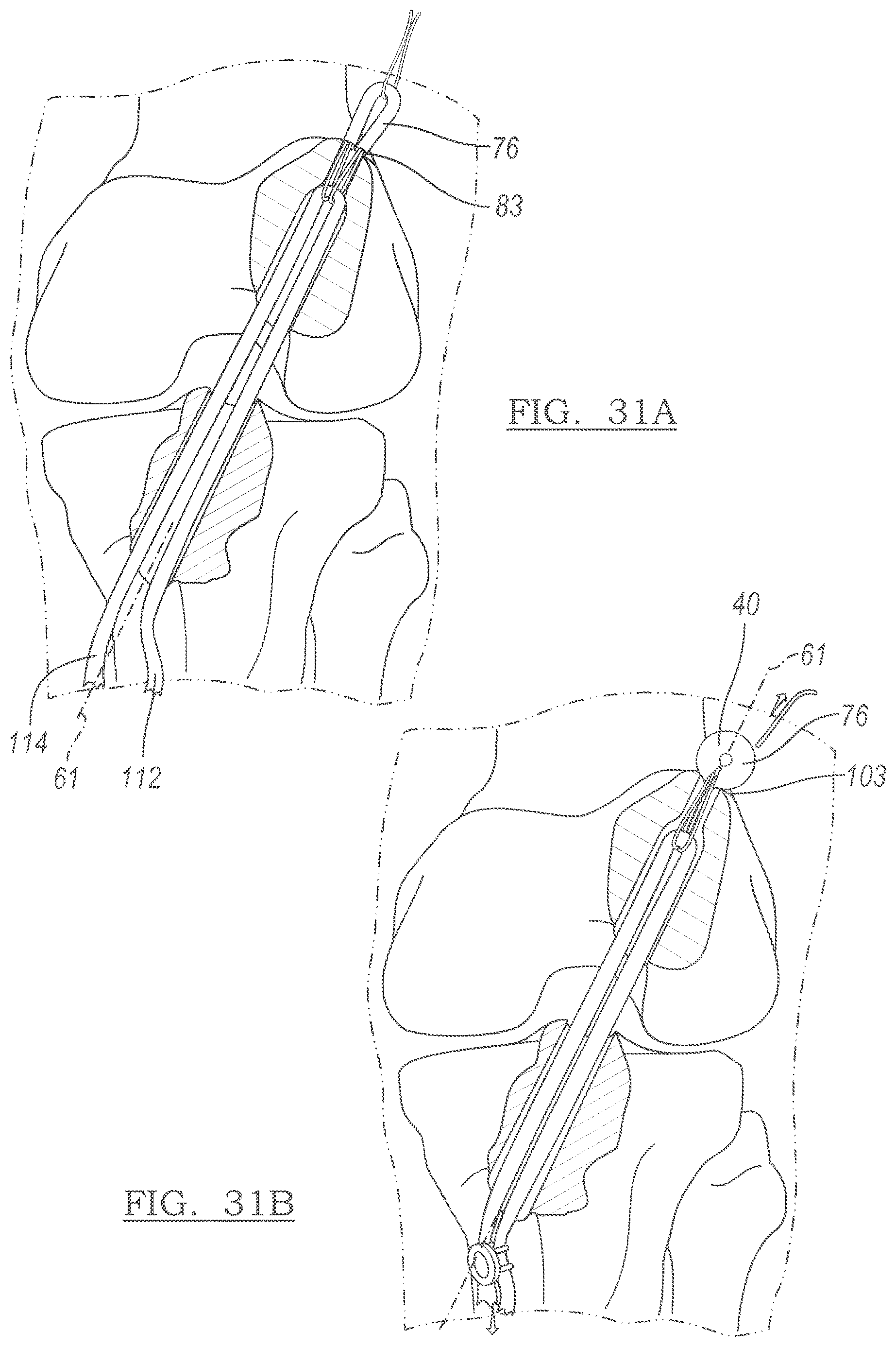 Patent US12551209 Figure 19 – Method and apparatus for coupling soft tissue to a bone