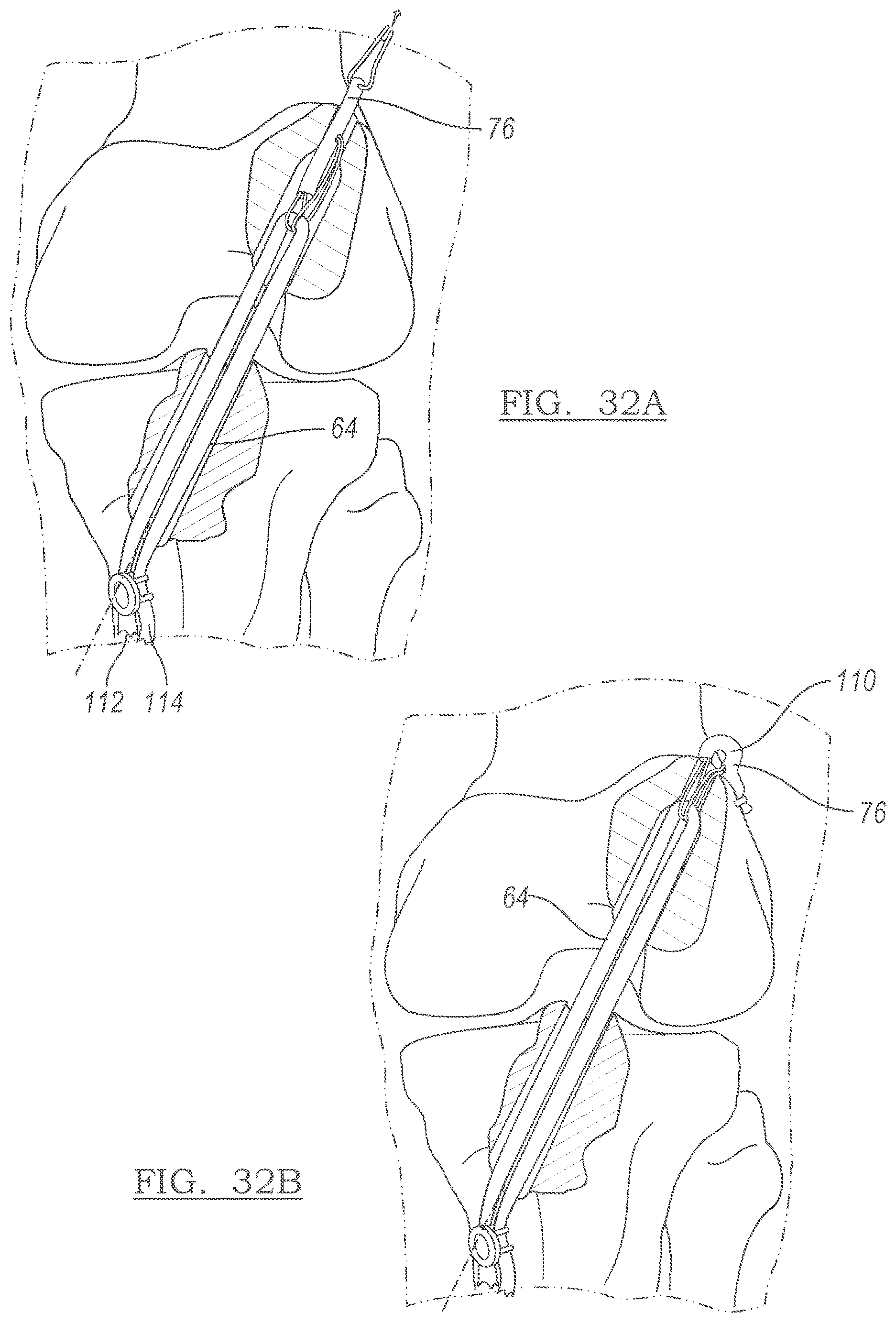 Patent US12551209 Figure 20 – Method and apparatus for coupling soft tissue to a bone