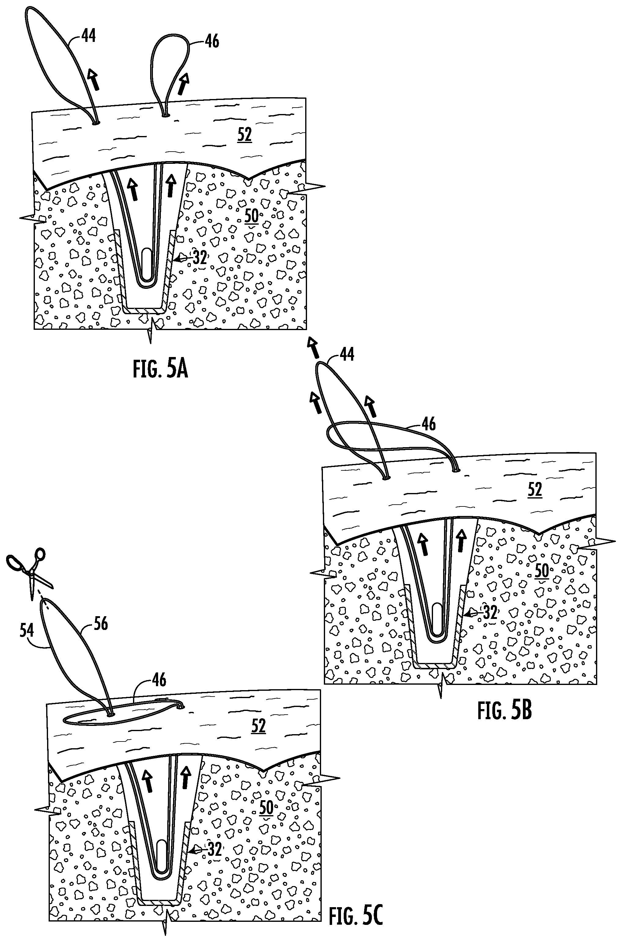 Patent US12551211 Figure 2 – Suture anchor