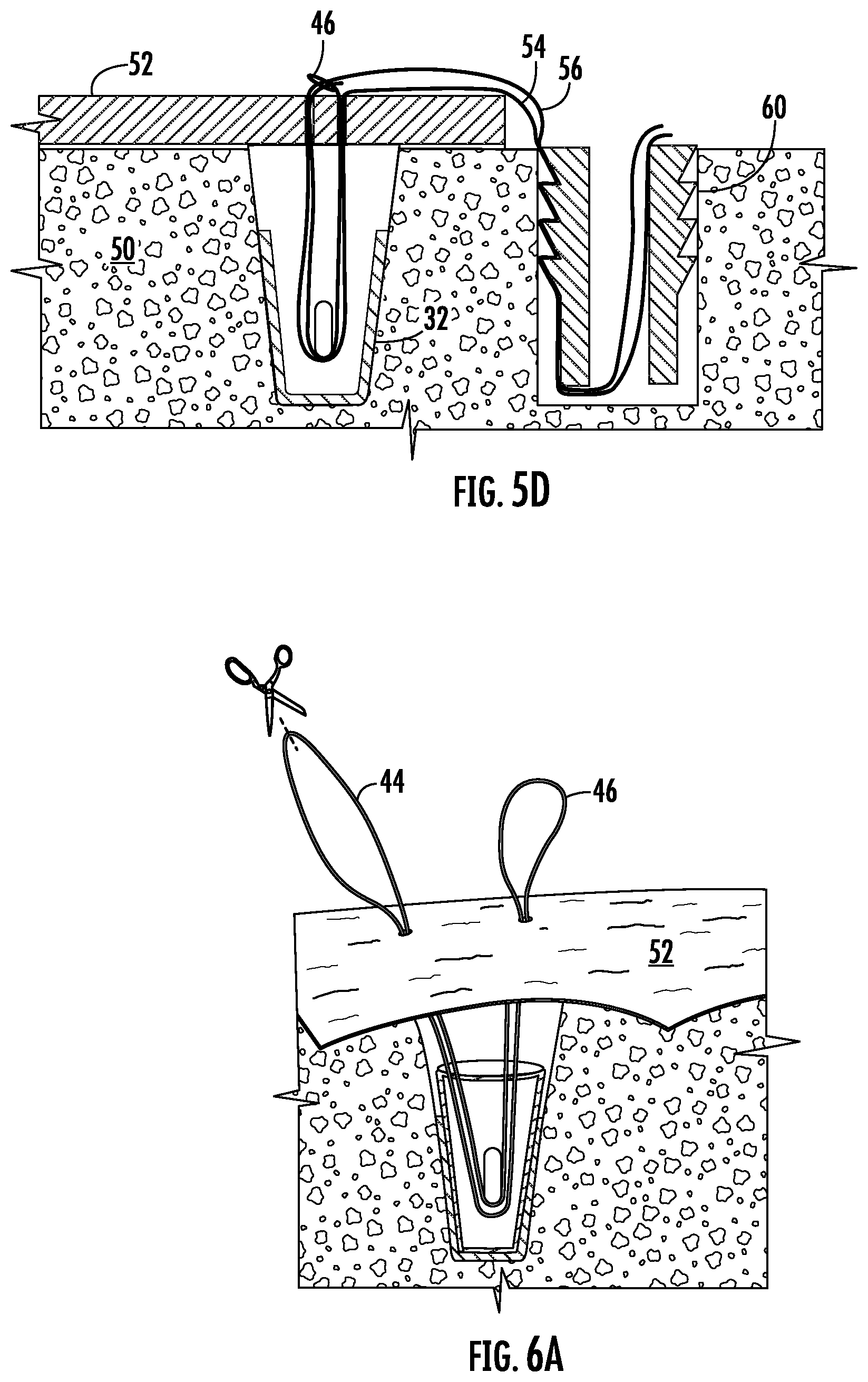 Patent US12551211 Figure 3 – Suture anchor