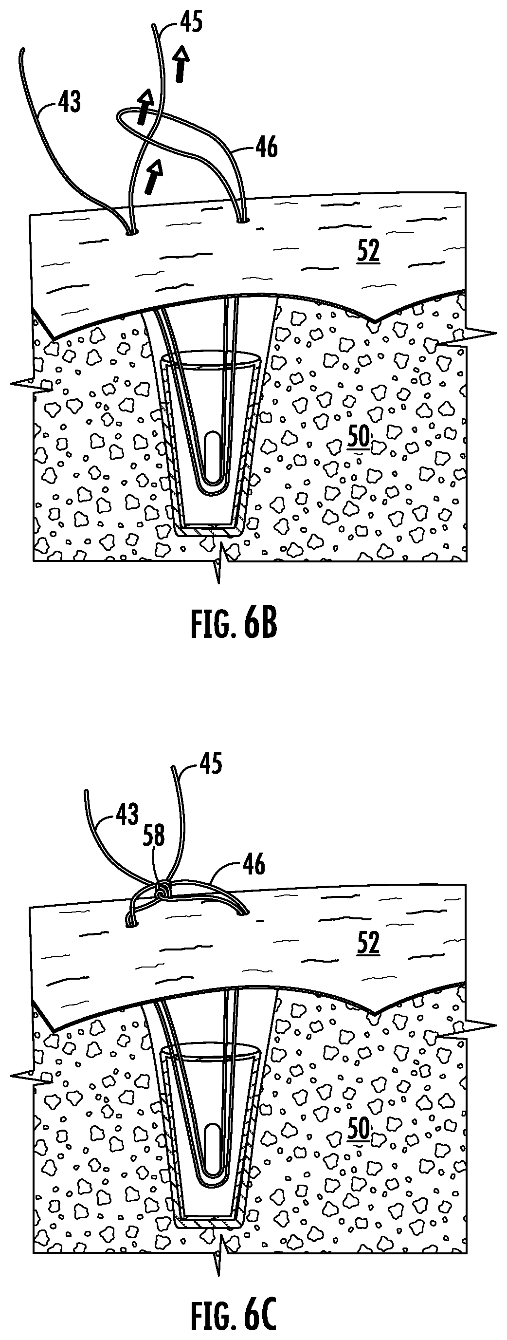 Patent US12551211 Figure 4 – Suture anchor