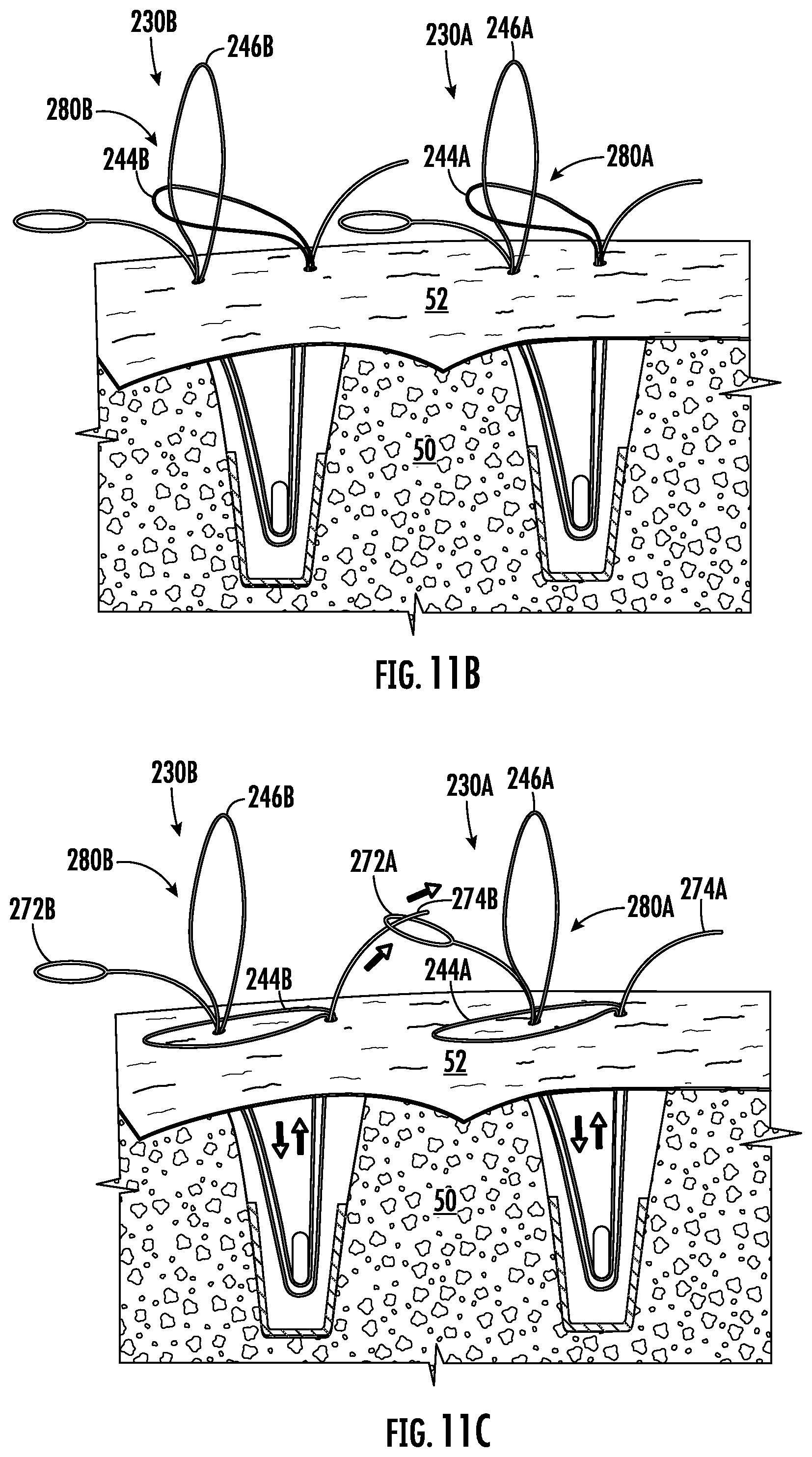 Patent US12551211 Figure 7 – Suture anchor