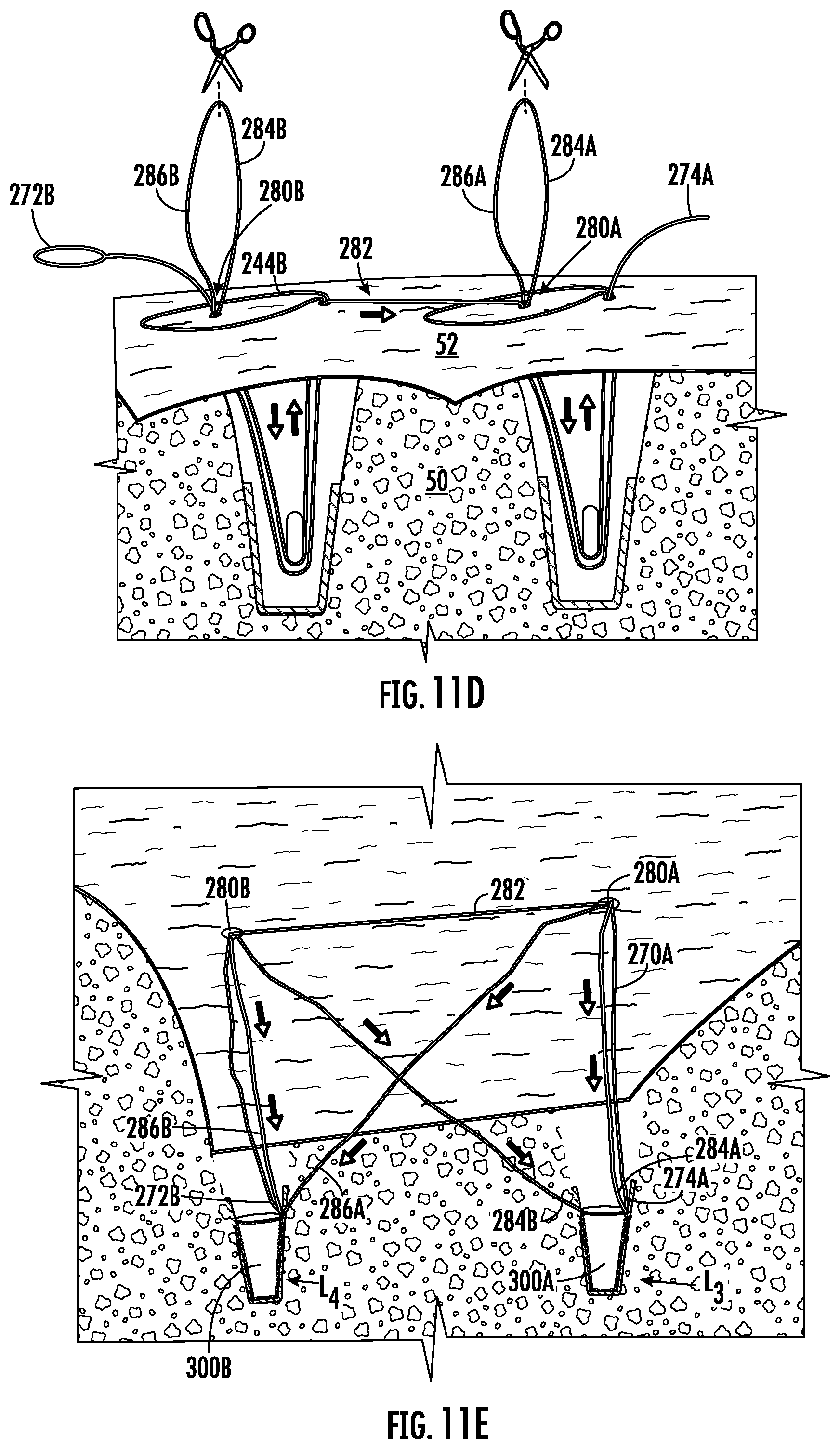 Patent US12551211 Figure 8 – Suture anchor