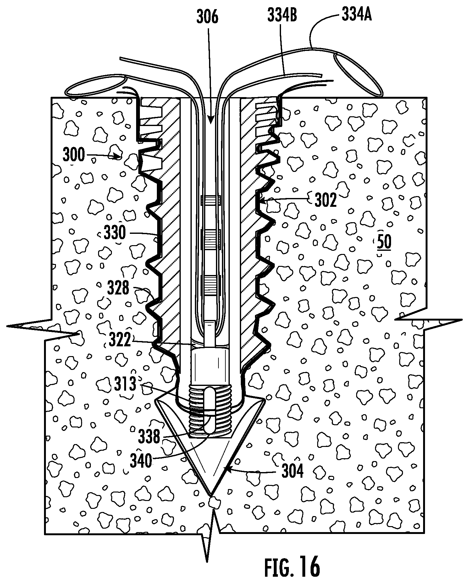 Patent US12551211 Figure 11 – Suture anchor
