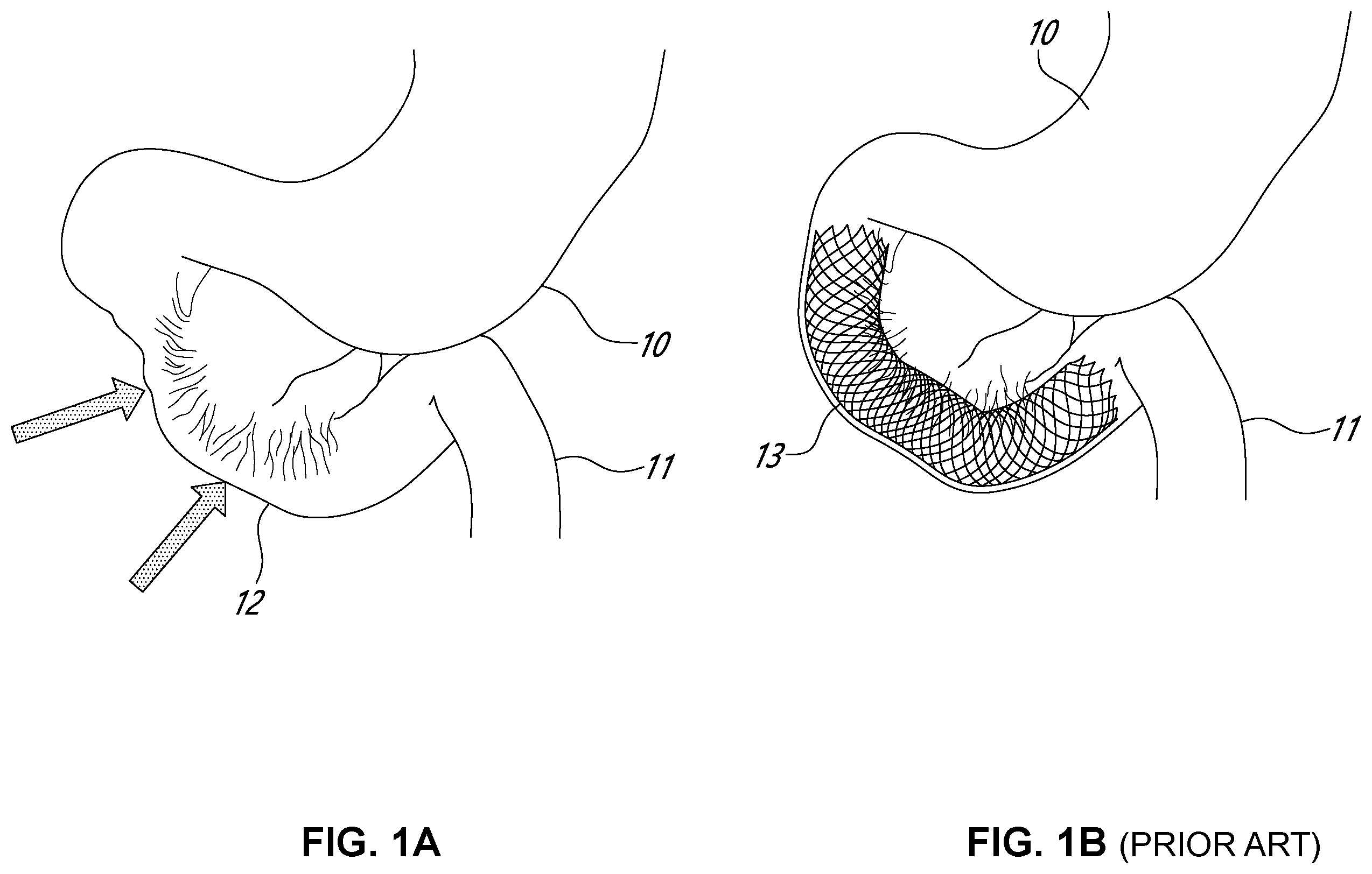 Patent US12551216 Figure 1 – Double-balloon catheter