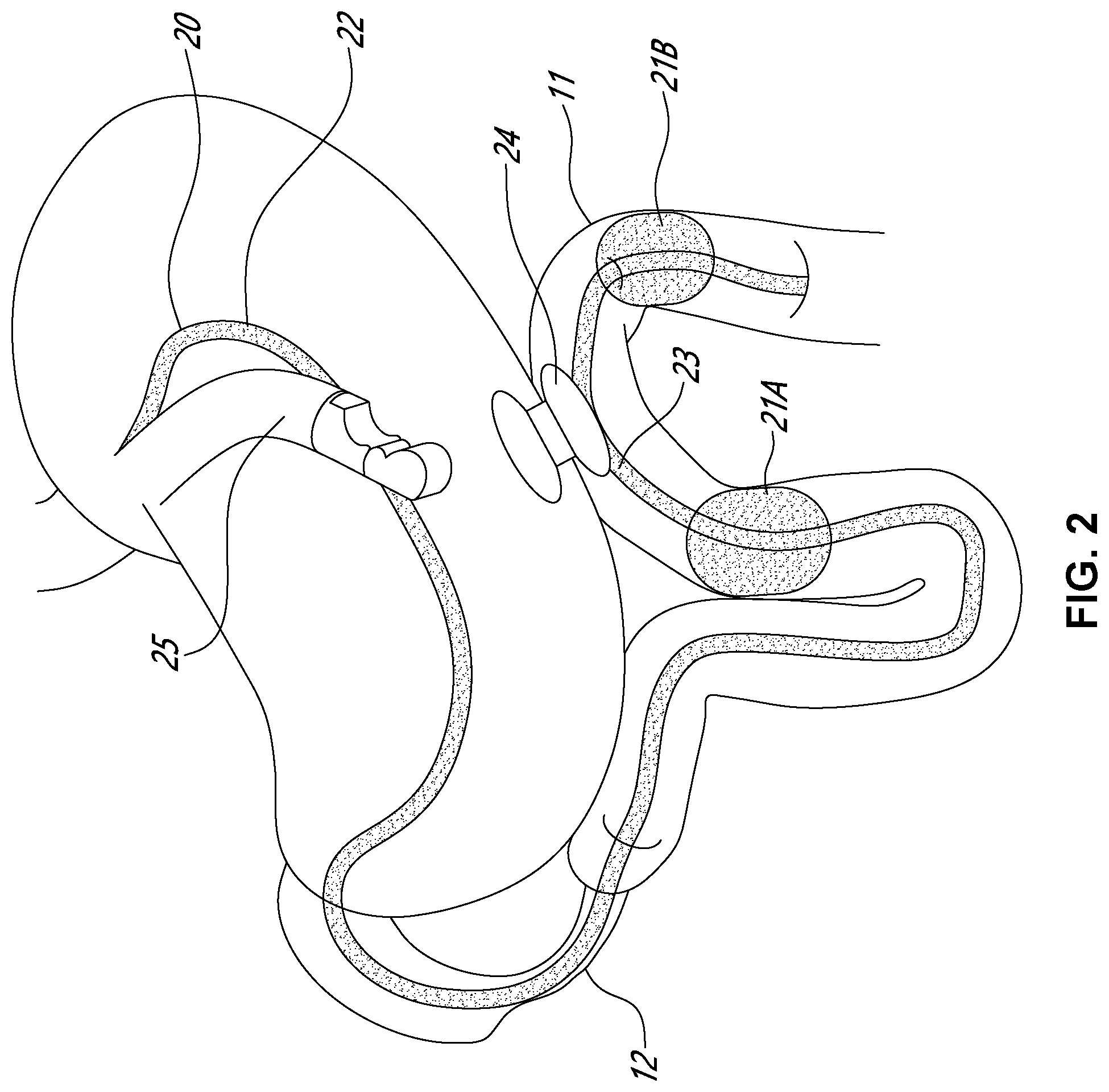 Patent US12551216 Figure 2 – Double-balloon catheter
