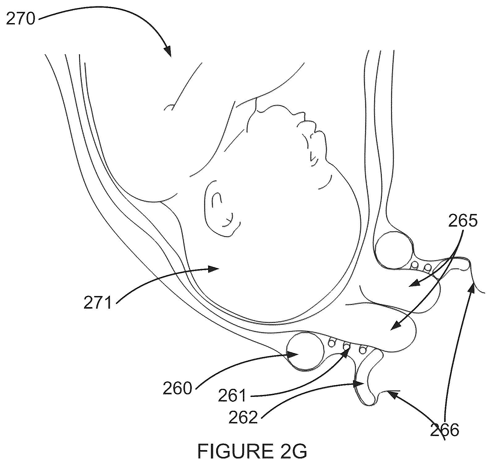 Patent US12551217 Figure 5 – Delaying pre-term birth