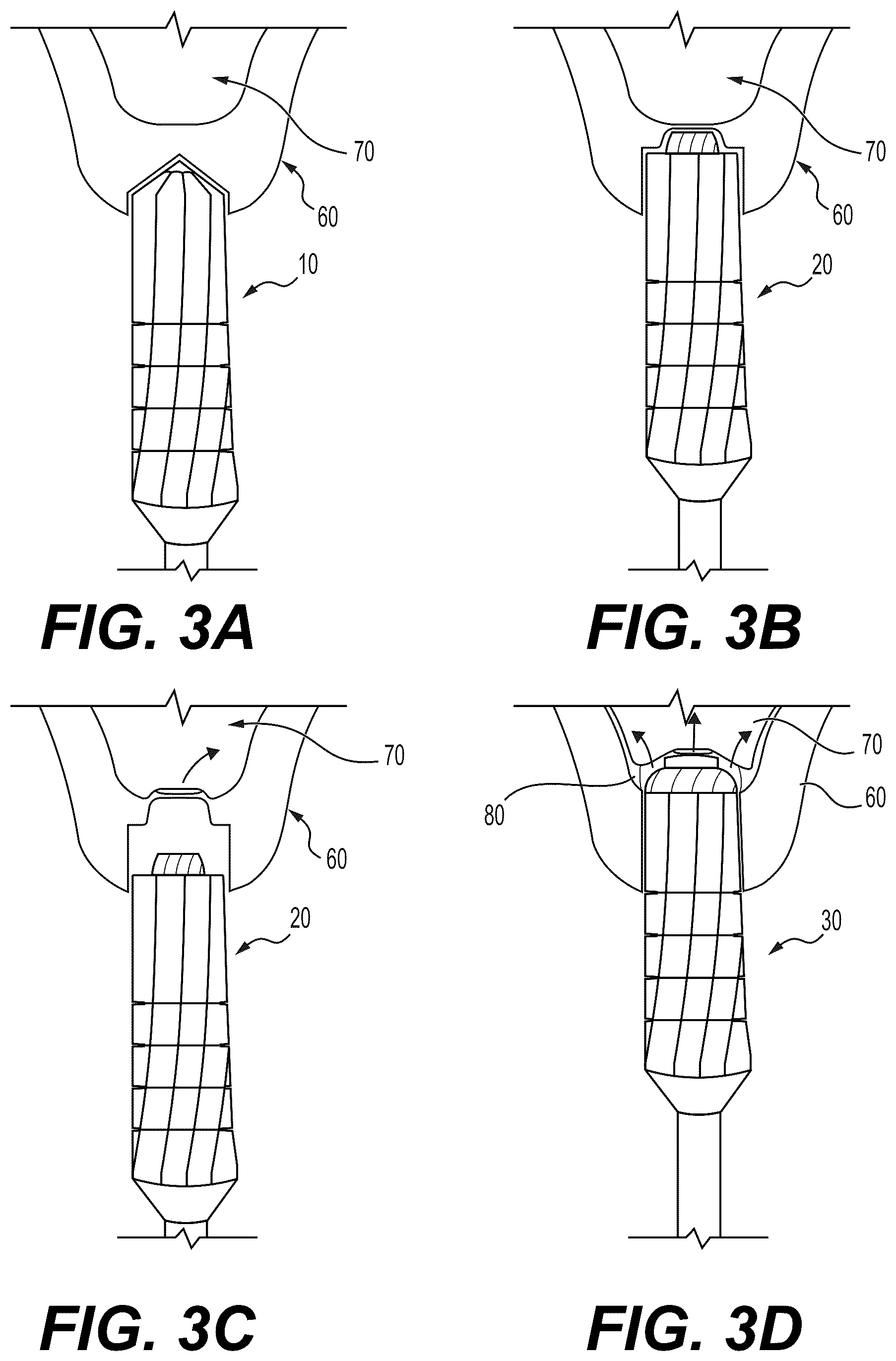 Patent US12551219 Figure 3 – Internal sinus lifting drill set
