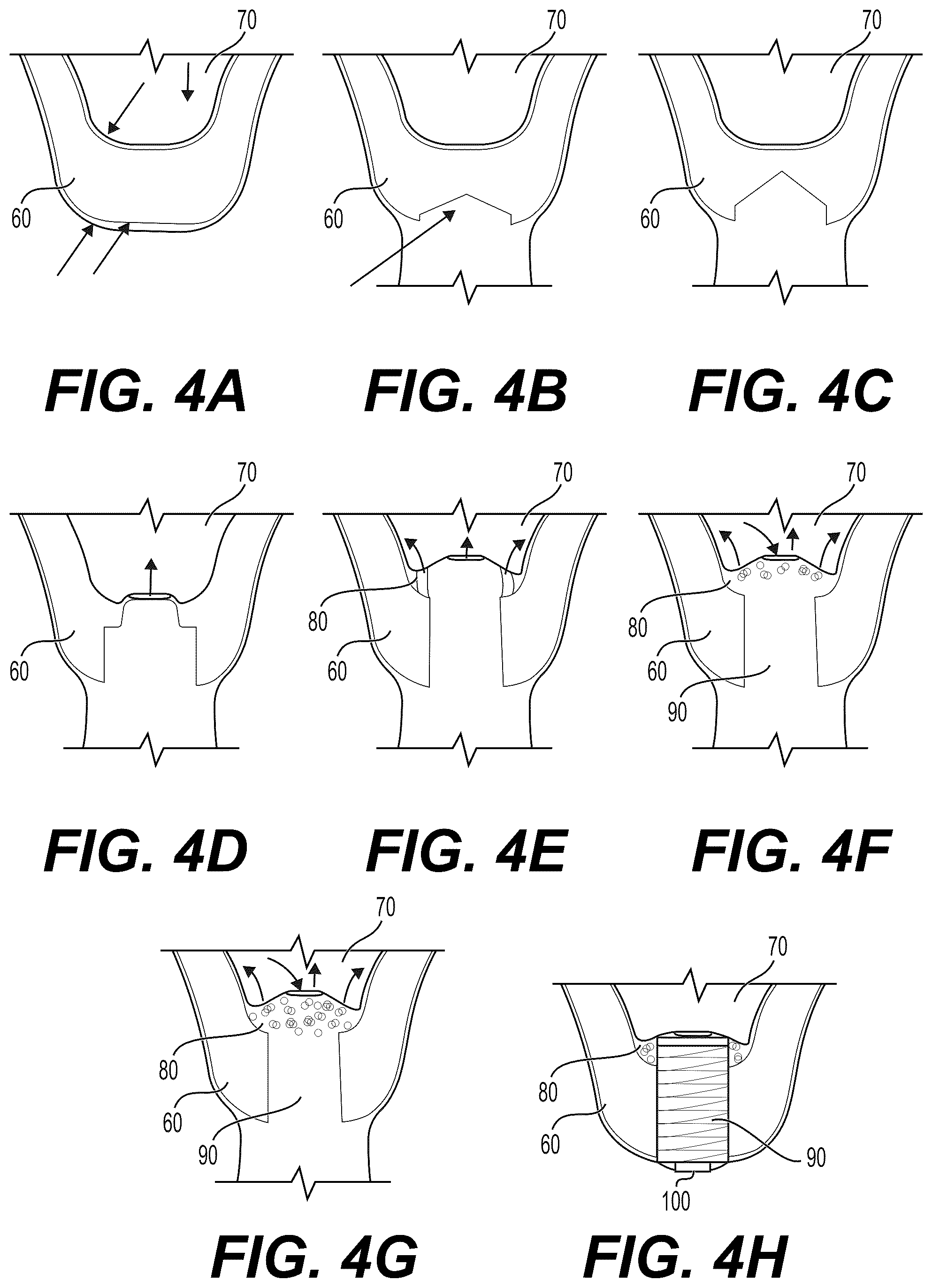 Patent US12551219 Figure 4 – Internal sinus lifting drill set