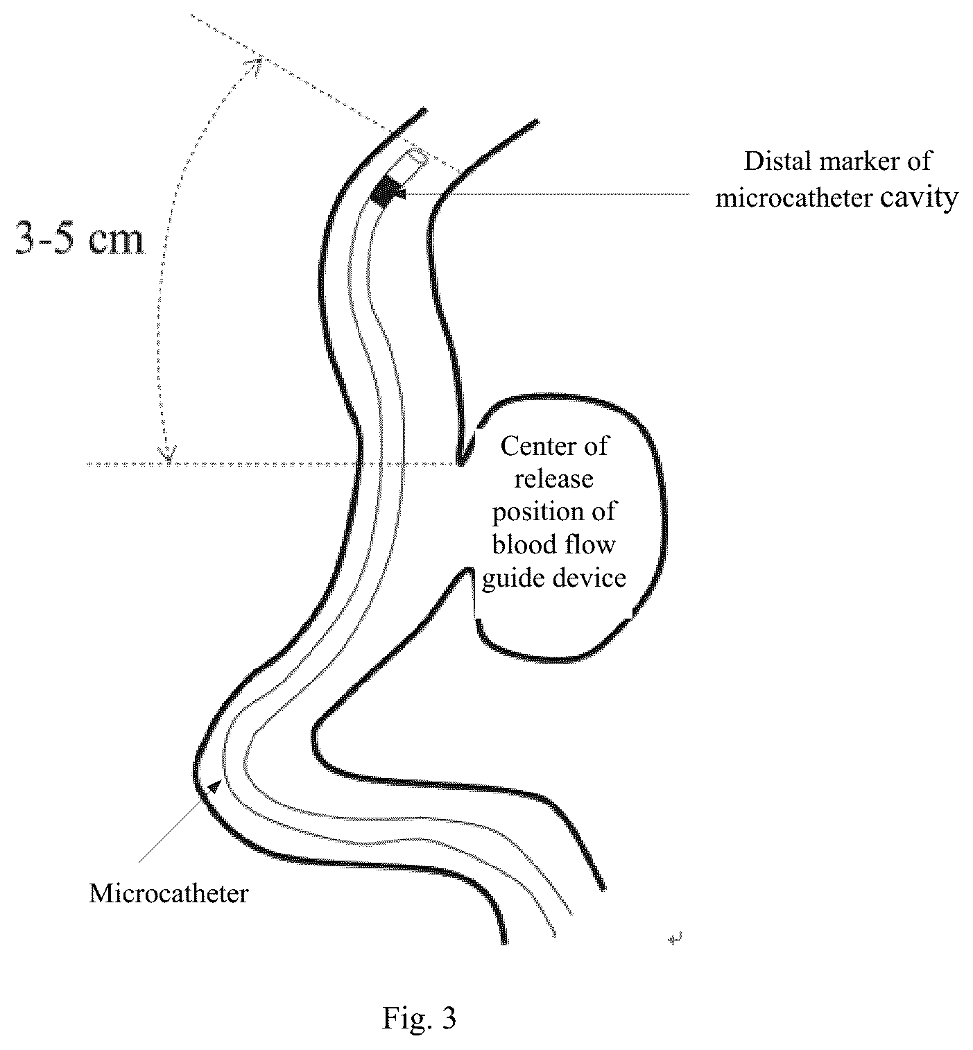 Patent US12551221 Figure 2 – Blood flow guide device conveying system capable of visual tracking and positioning, and tracking and positioning method