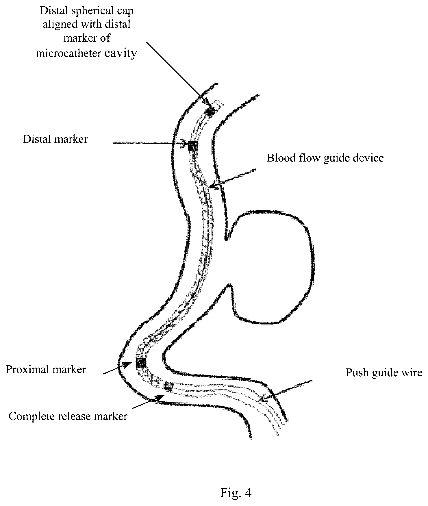 Patent US12551221 Figure 3 – Blood flow guide device conveying system capable of visual tracking and positioning, and tracking and positioning method