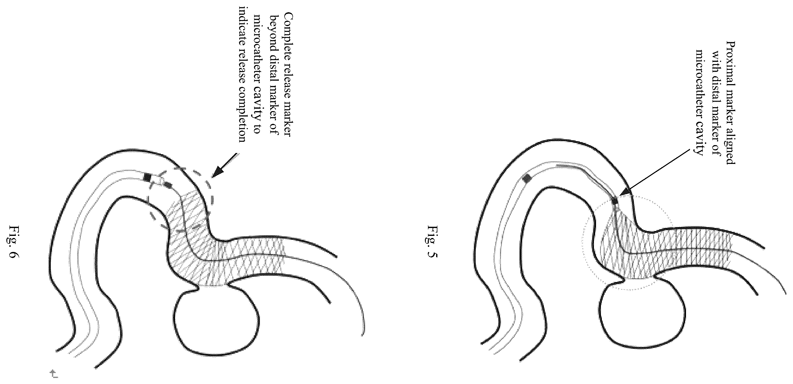 Patent US12551221 Figure 4 – Blood flow guide device conveying system capable of visual tracking and positioning, and tracking and positioning method