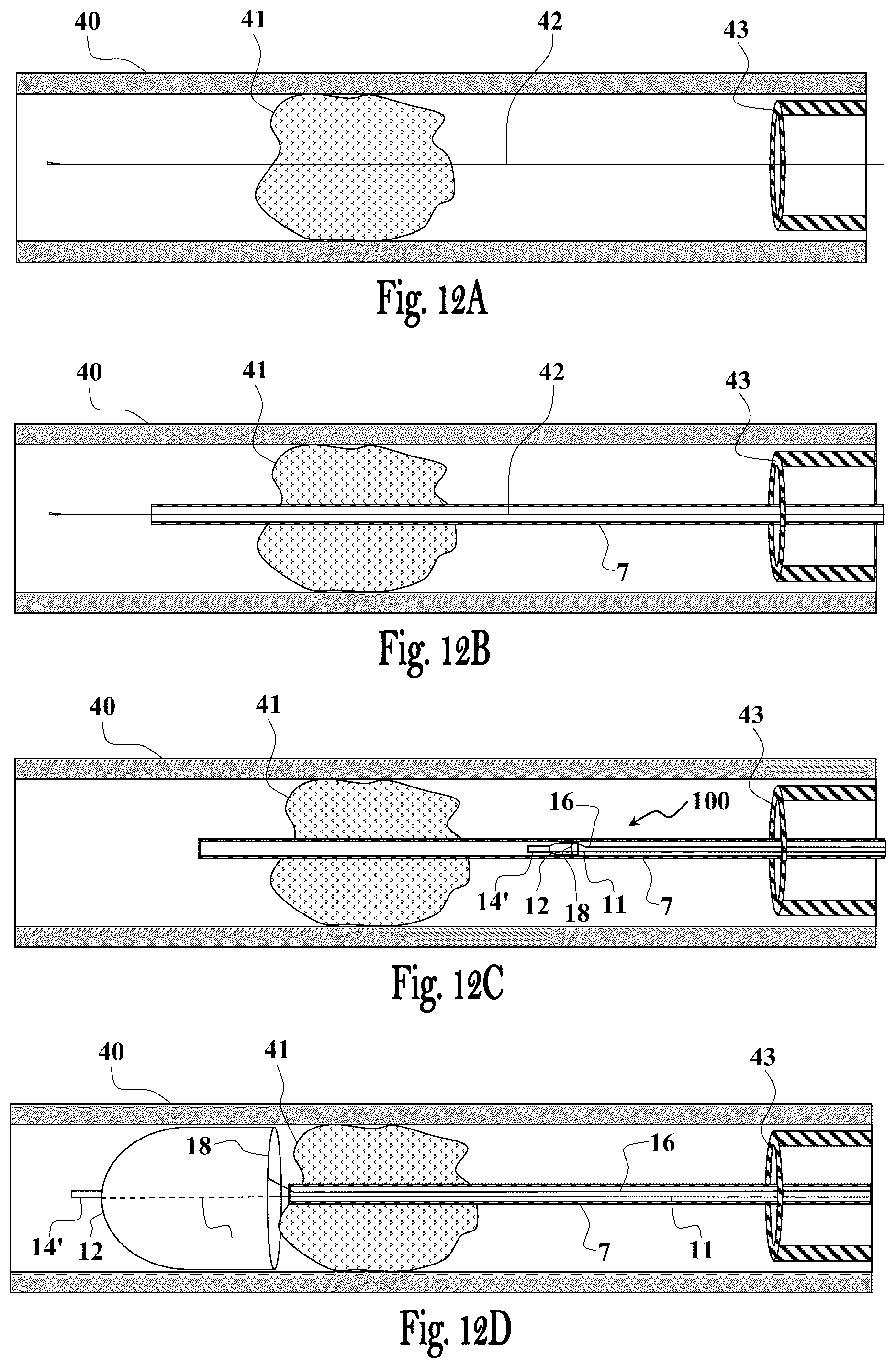 Patent US12551224 Figure 13 – Clot removal device and method