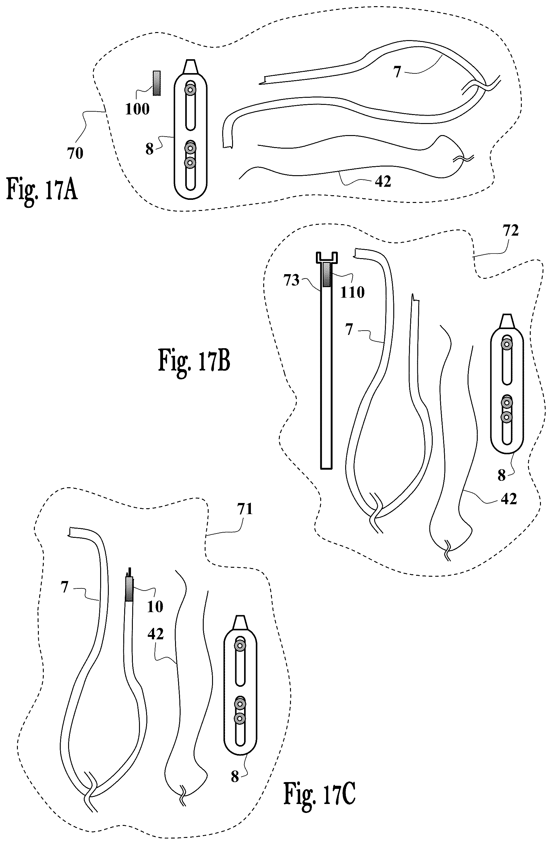 Patent US12551224 Figure 18 – Clot removal device and method