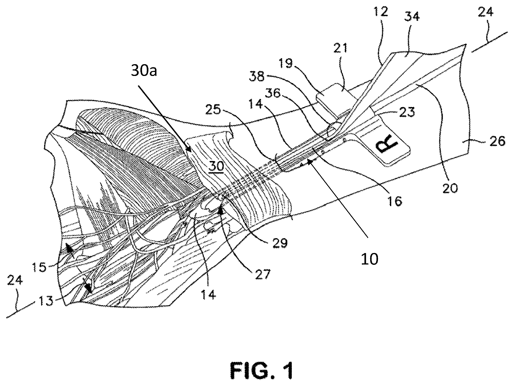 Patent US12551229 Figure 1 – Integrated endoscopic ligament release device with dual handles