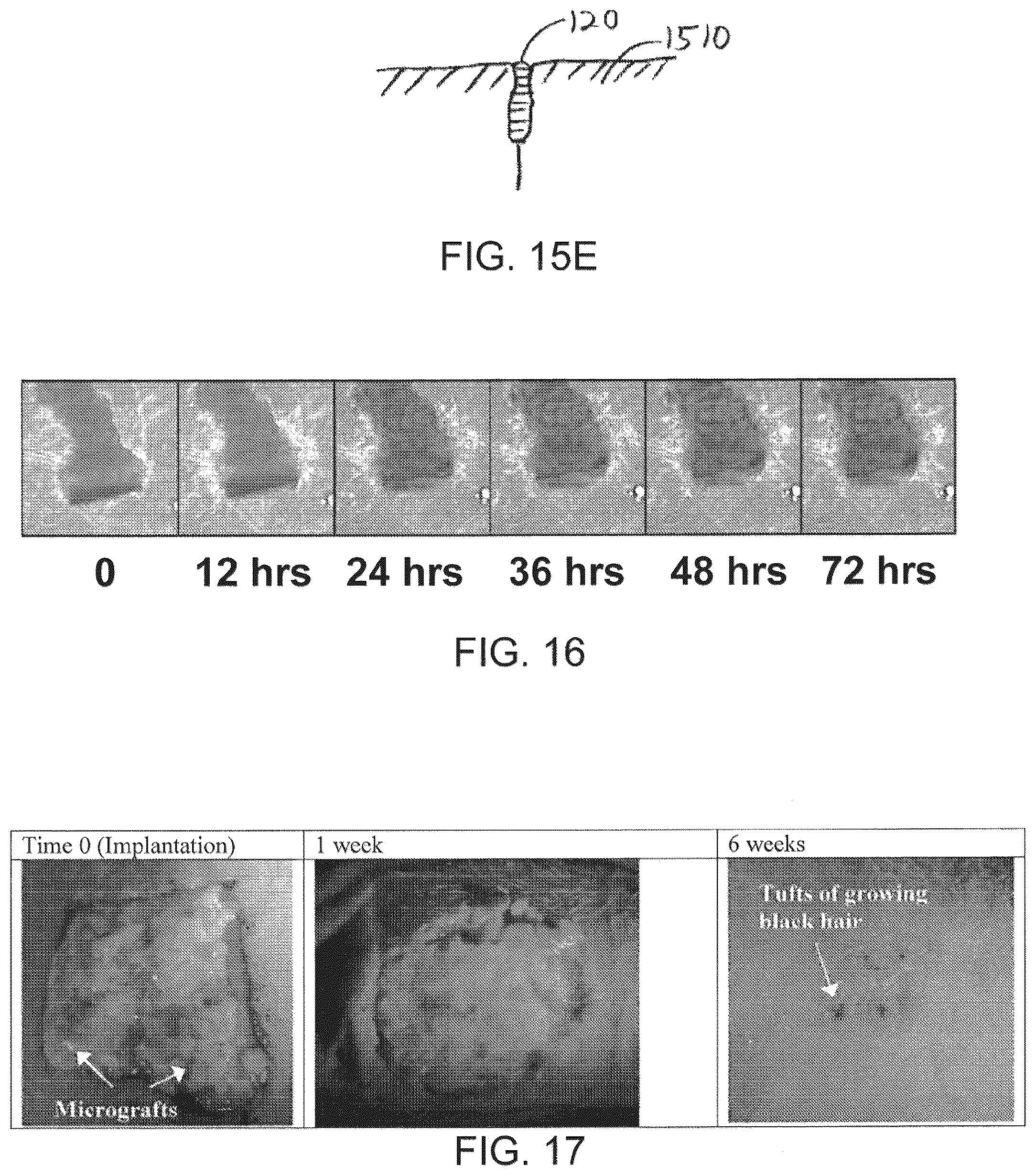 Patent US12551232 Figure 13 – Method and apparatus for tissue grafting and copying