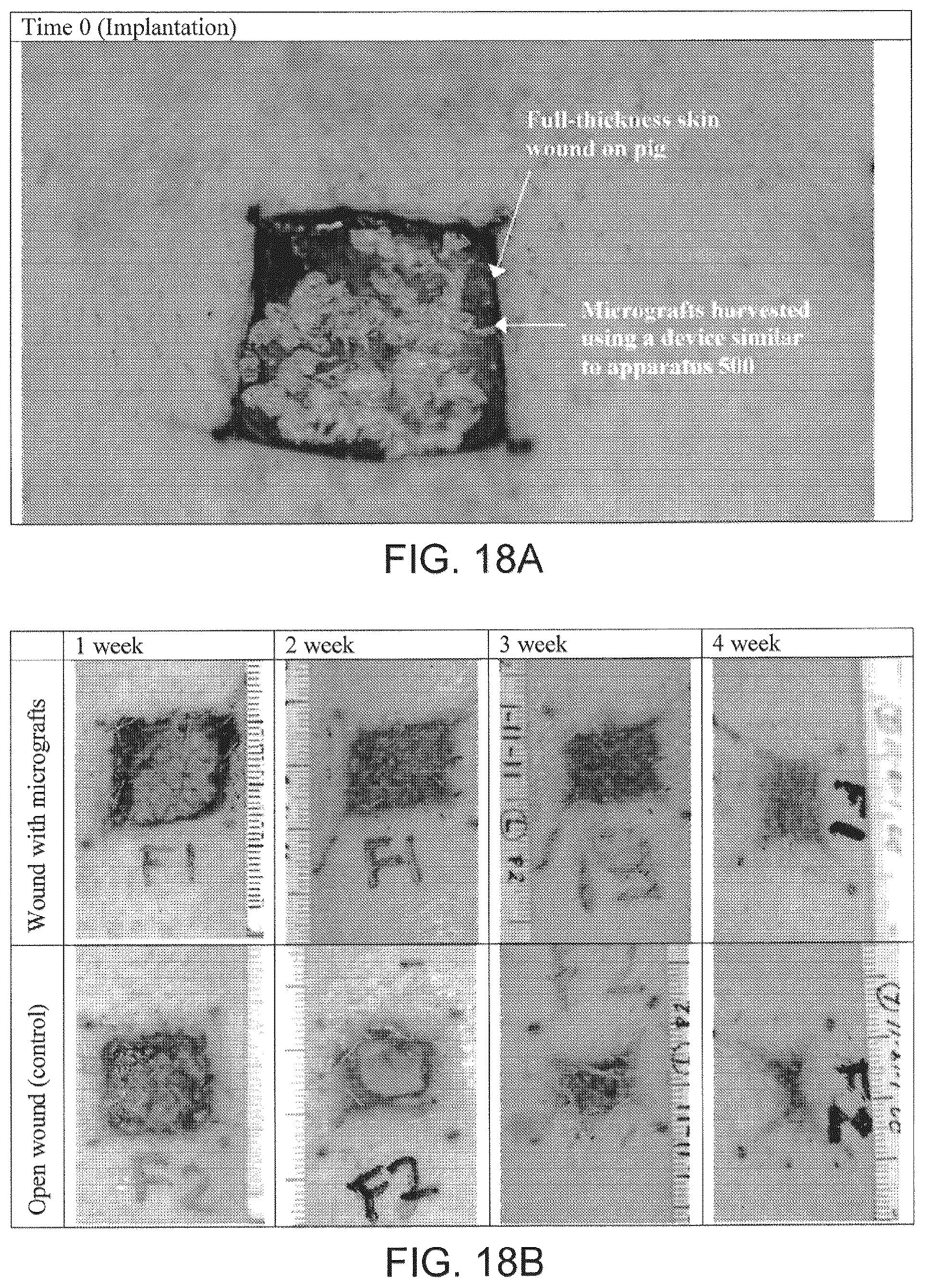 Patent US12551232 Figure 14 – Method and apparatus for tissue grafting and copying