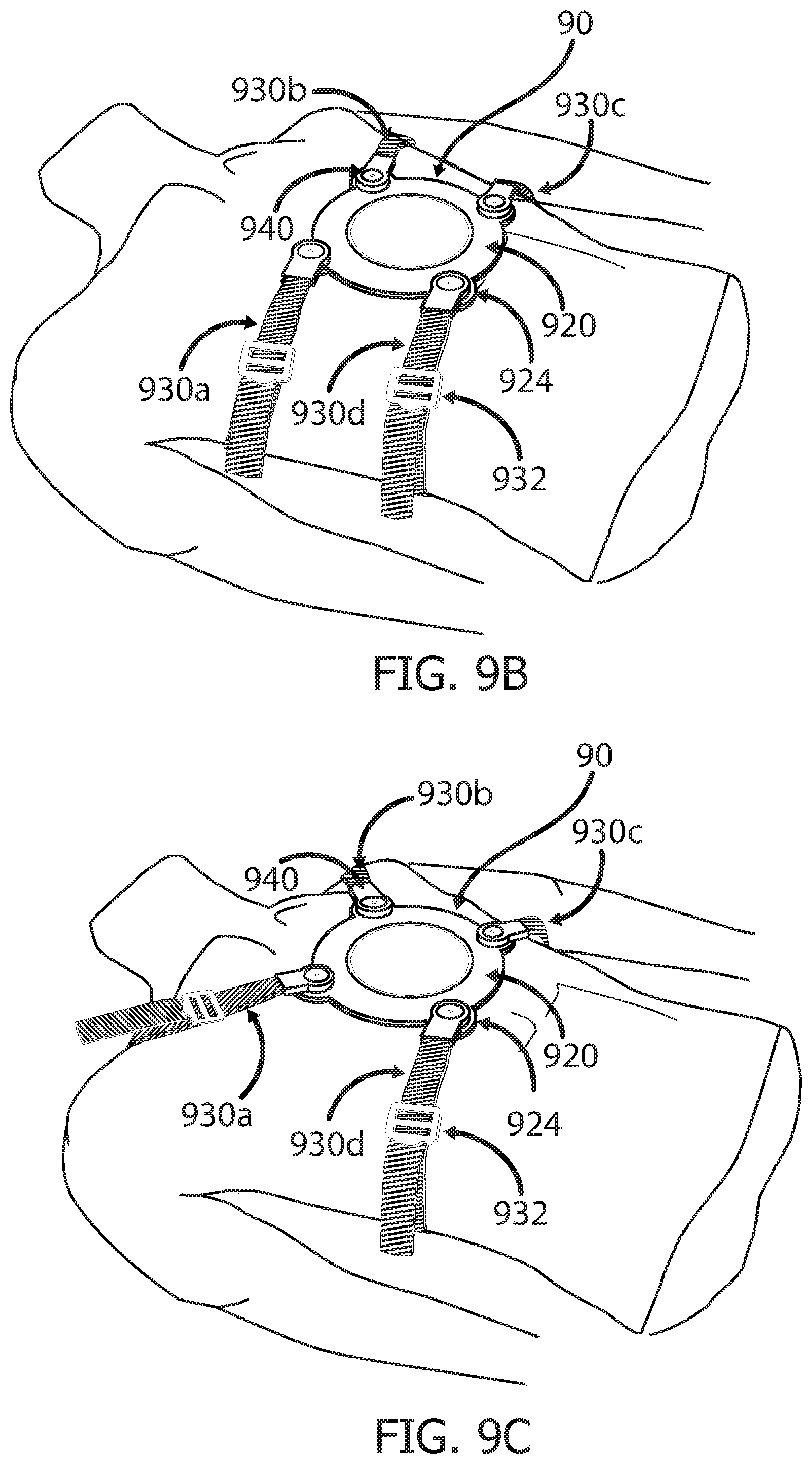 Patent US12551233 Figure 10 – Devices and methods for attaching a medical device to a subject