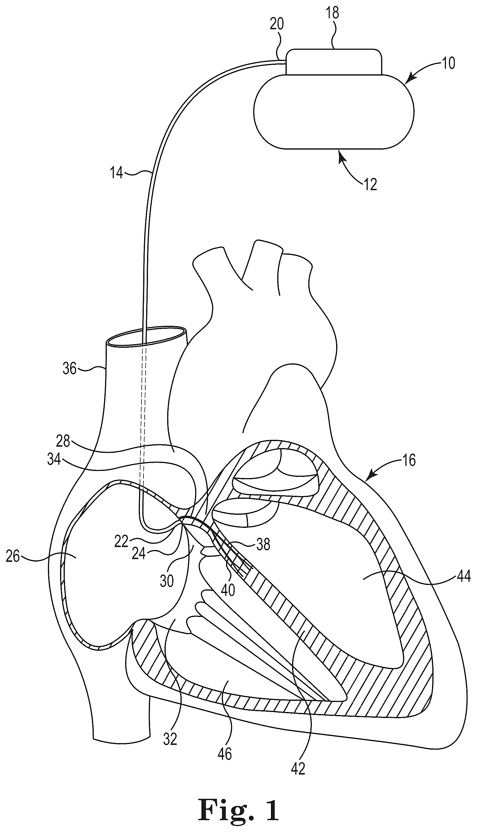Patent US12551235 — Bundle of His lead delivery catheter, system and method — Figure 1