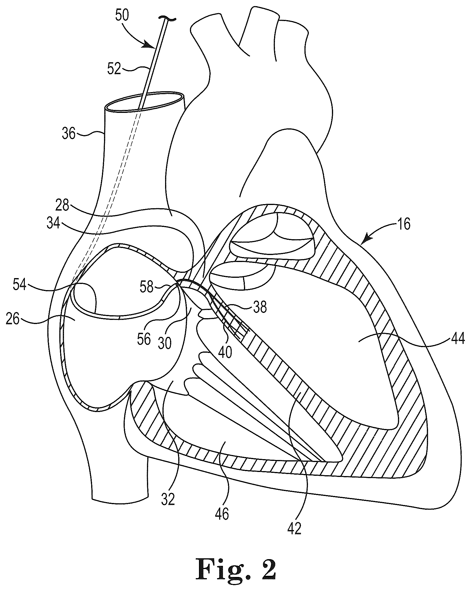 Patent US12551235 Figure 2 – Bundle of His lead delivery catheter, system and method