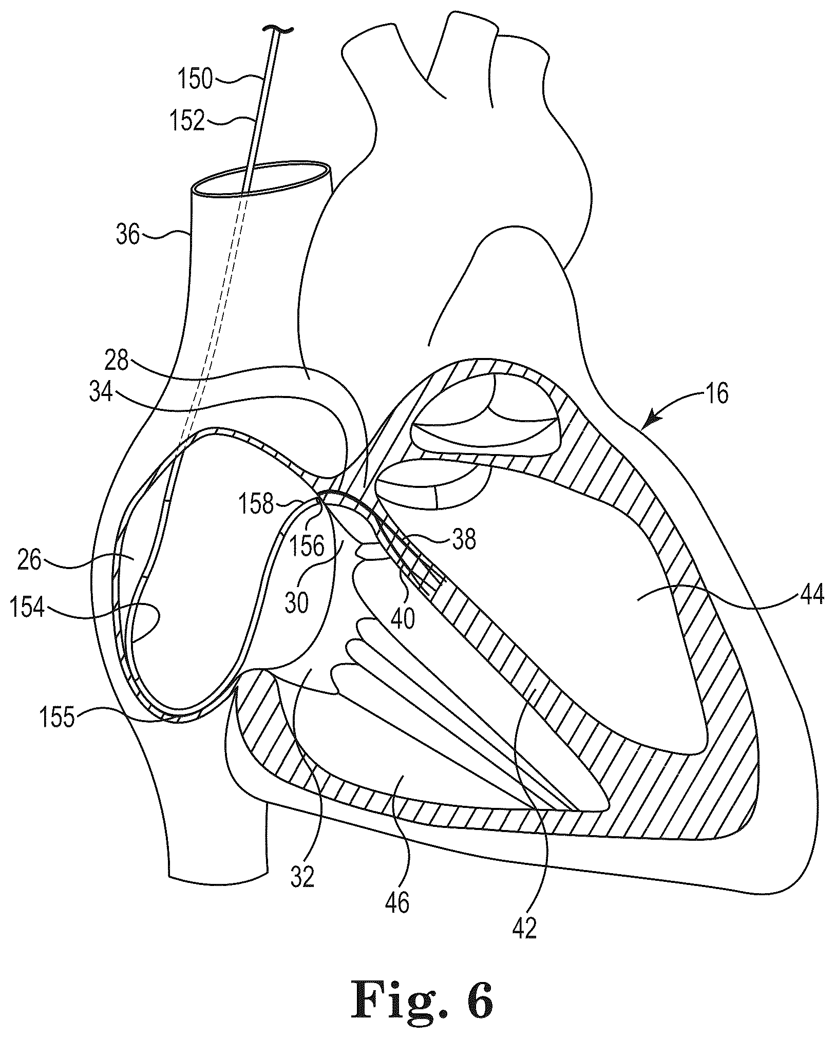 Patent US12551235 Figure 5 – Bundle of His lead delivery catheter, system and method