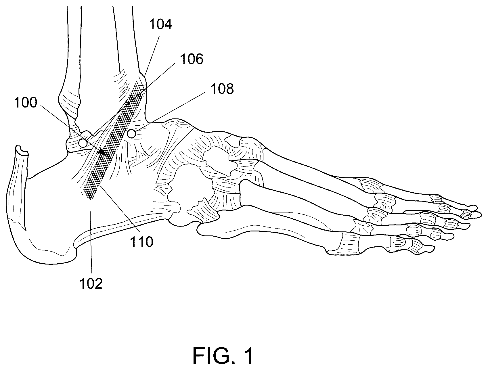 Patent US12551238 Figure 1 – Fiber implant with interwoven different materials