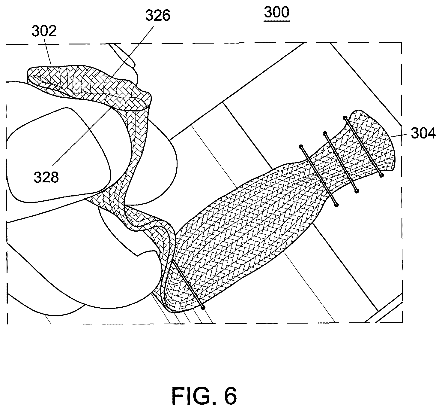 Patent US12551238 Figure 4 – Fiber implant with interwoven different materials