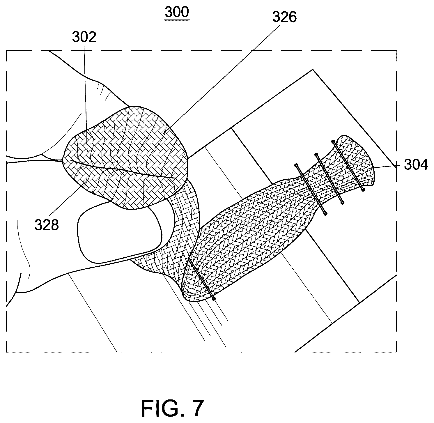 Patent US12551238 Figure 5 – Fiber implant with interwoven different materials