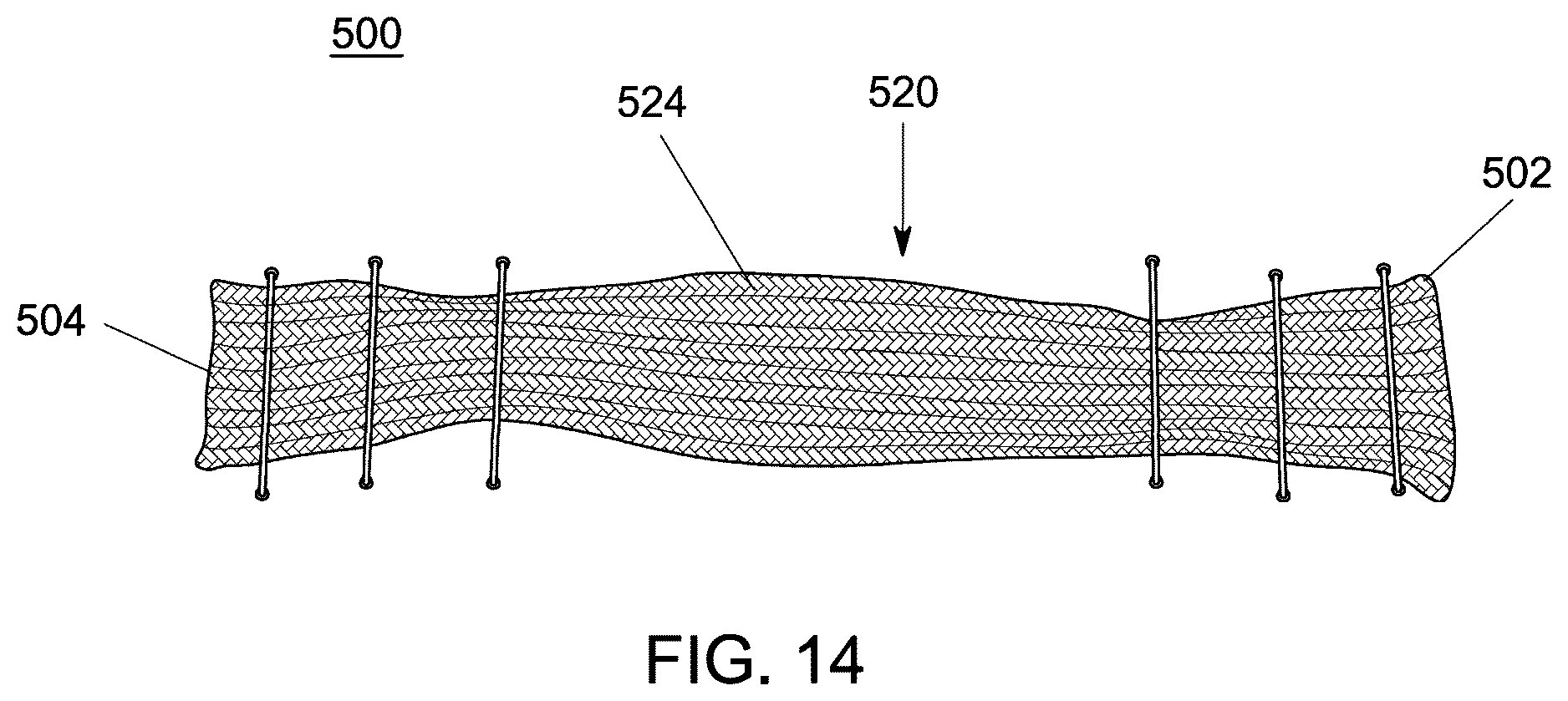 Patent US12551238 Figure 11 – Fiber implant with interwoven different materials