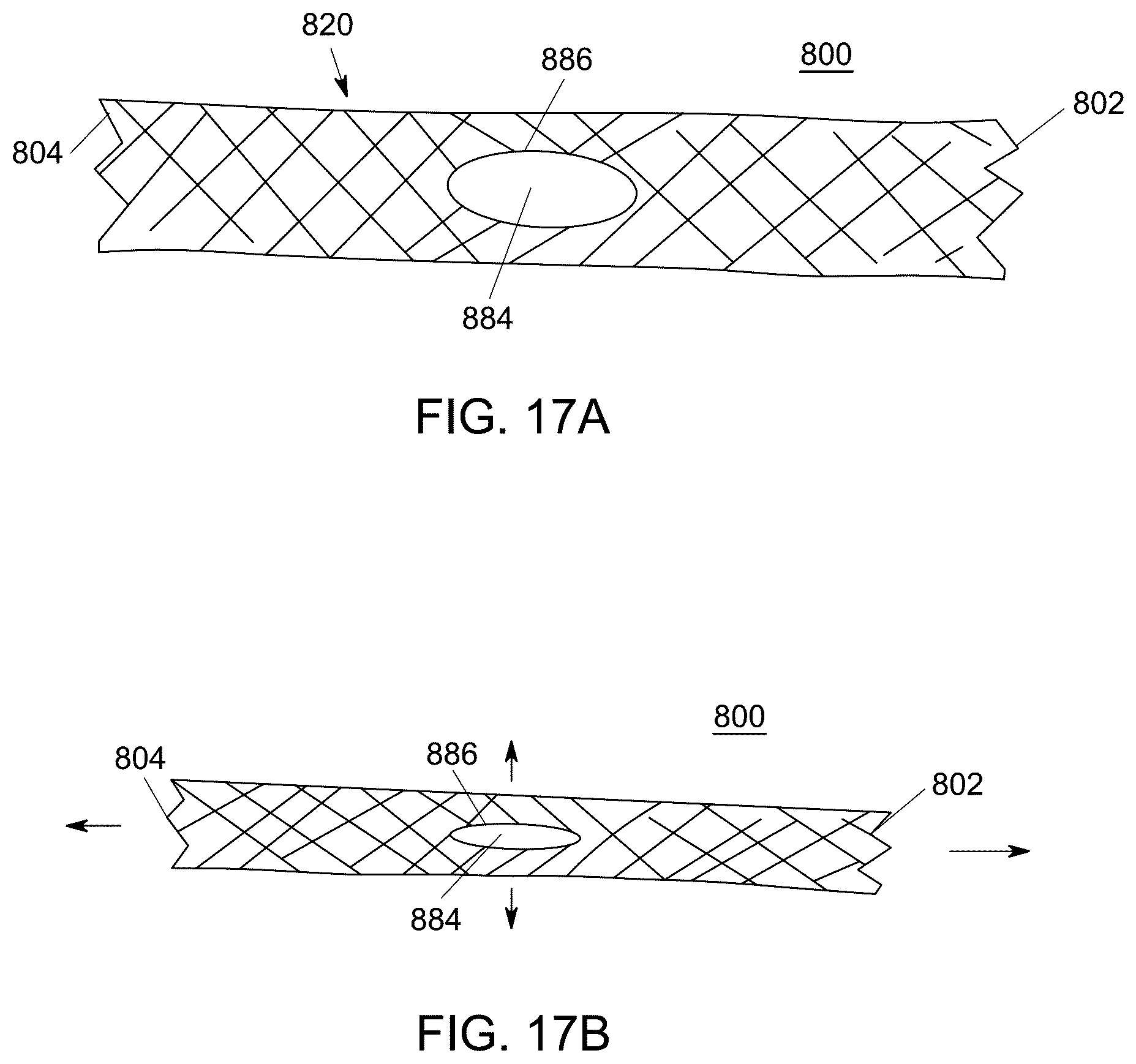 Patent US12551238 Figure 14 – Fiber implant with interwoven different materials