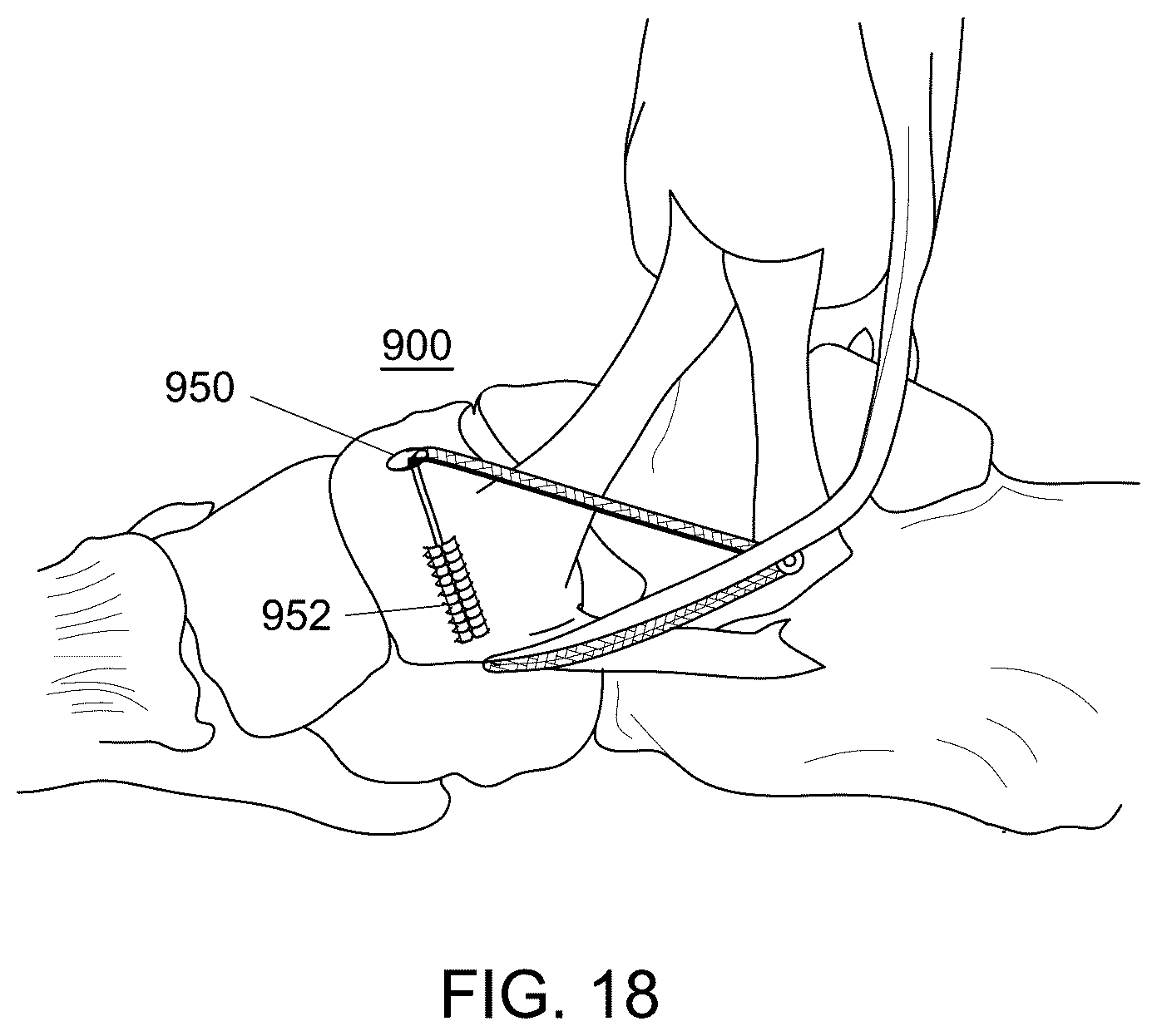 Patent US12551238 Figure 15 – Fiber implant with interwoven different materials