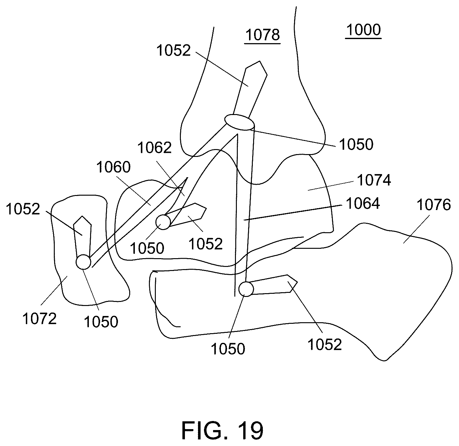 Patent US12551238 Figure 16 – Fiber implant with interwoven different materials
