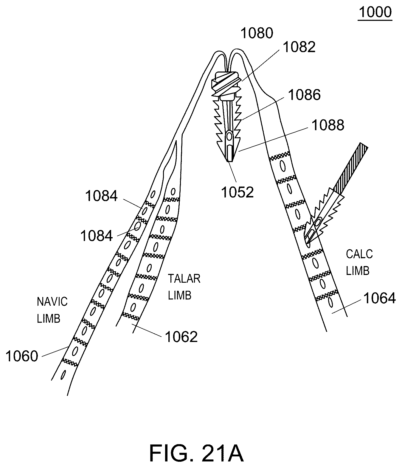 Patent US12551238 Figure 18 – Fiber implant with interwoven different materials