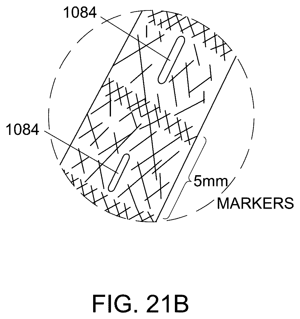 Patent US12551238 Figure 19 – Fiber implant with interwoven different materials