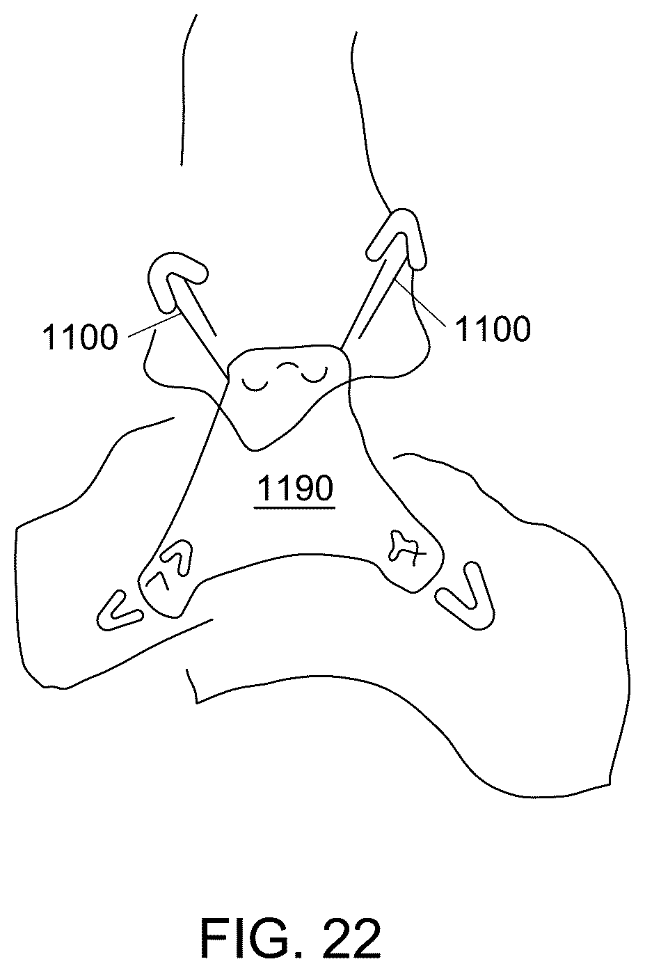Patent US12551238 Figure 20 – Fiber implant with interwoven different materials