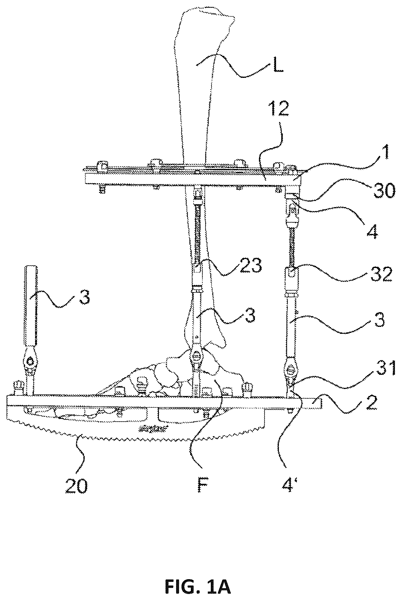 Patent US12551239 Figure 1 – External fixator system