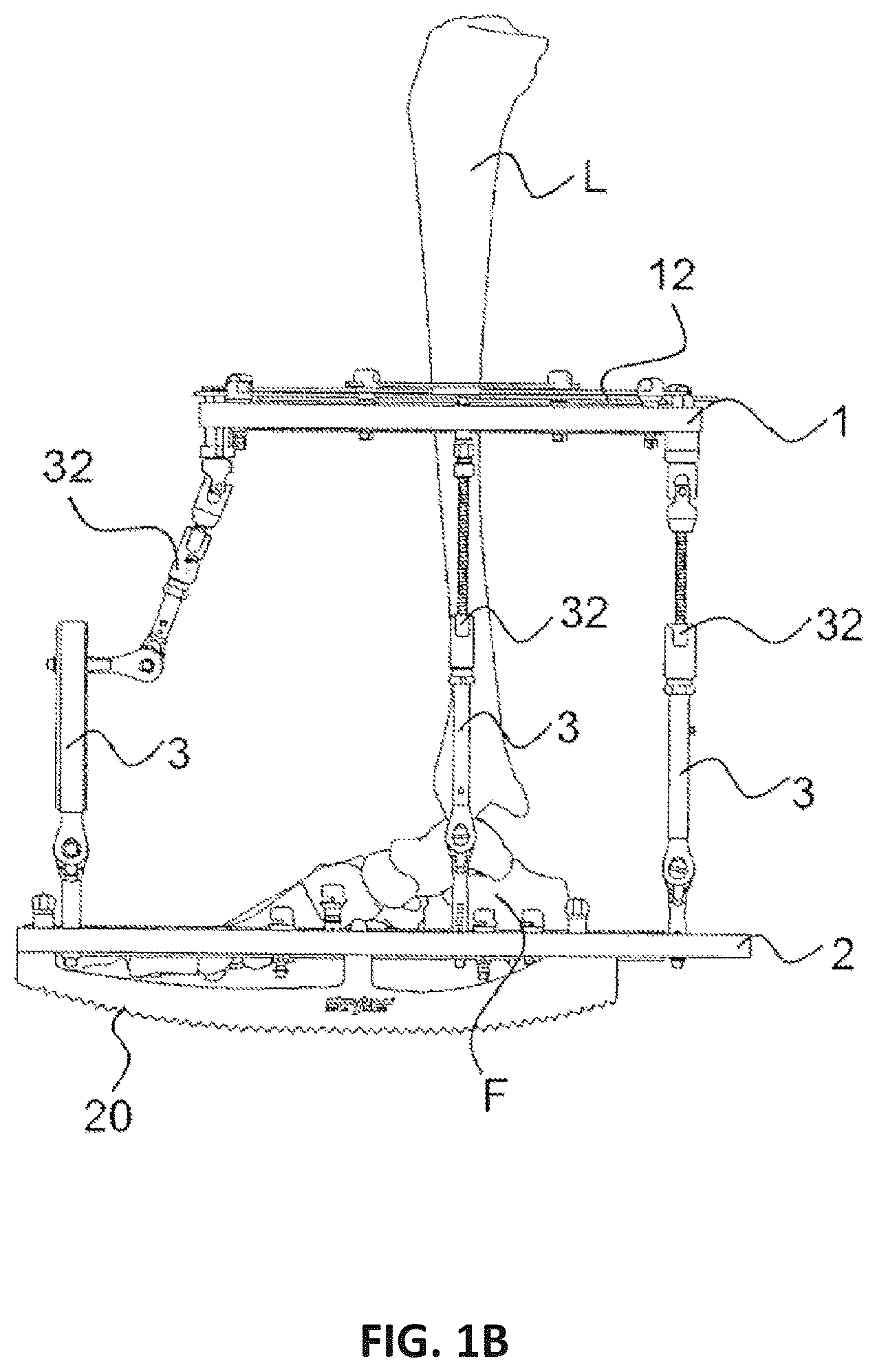Patent US12551239 Figure 2 – External fixator system
