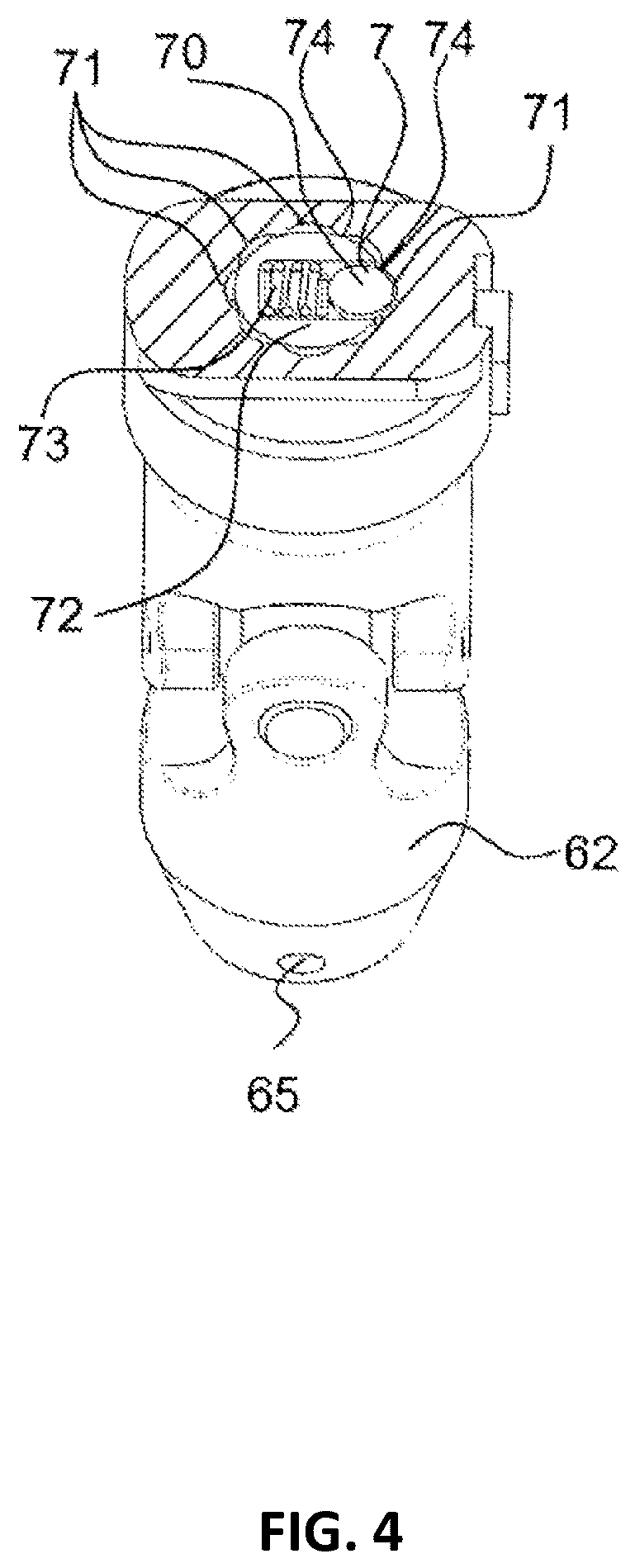 Patent US12551239 Figure 6 – External fixator system
