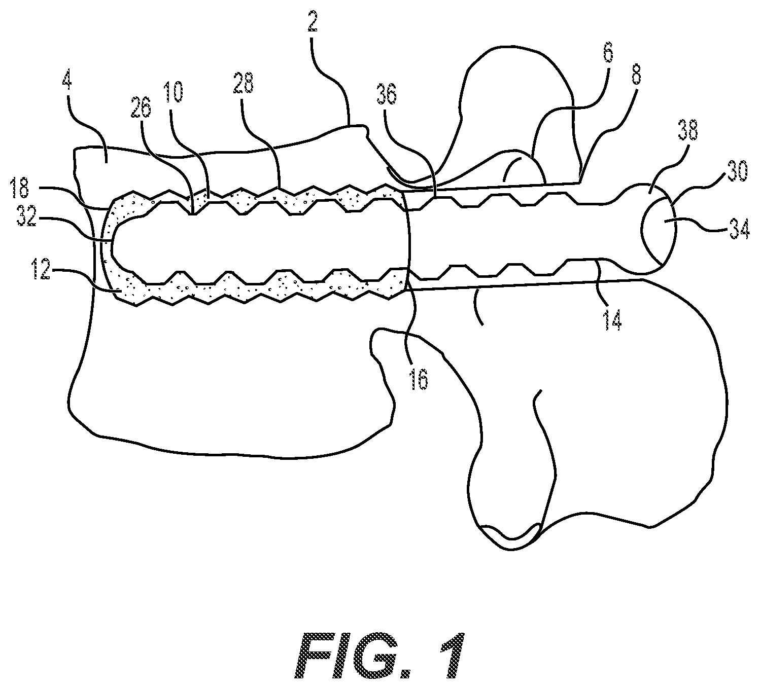 Patent US12551241 Figure 1 – Expandable bone core for pedicle screw fixation