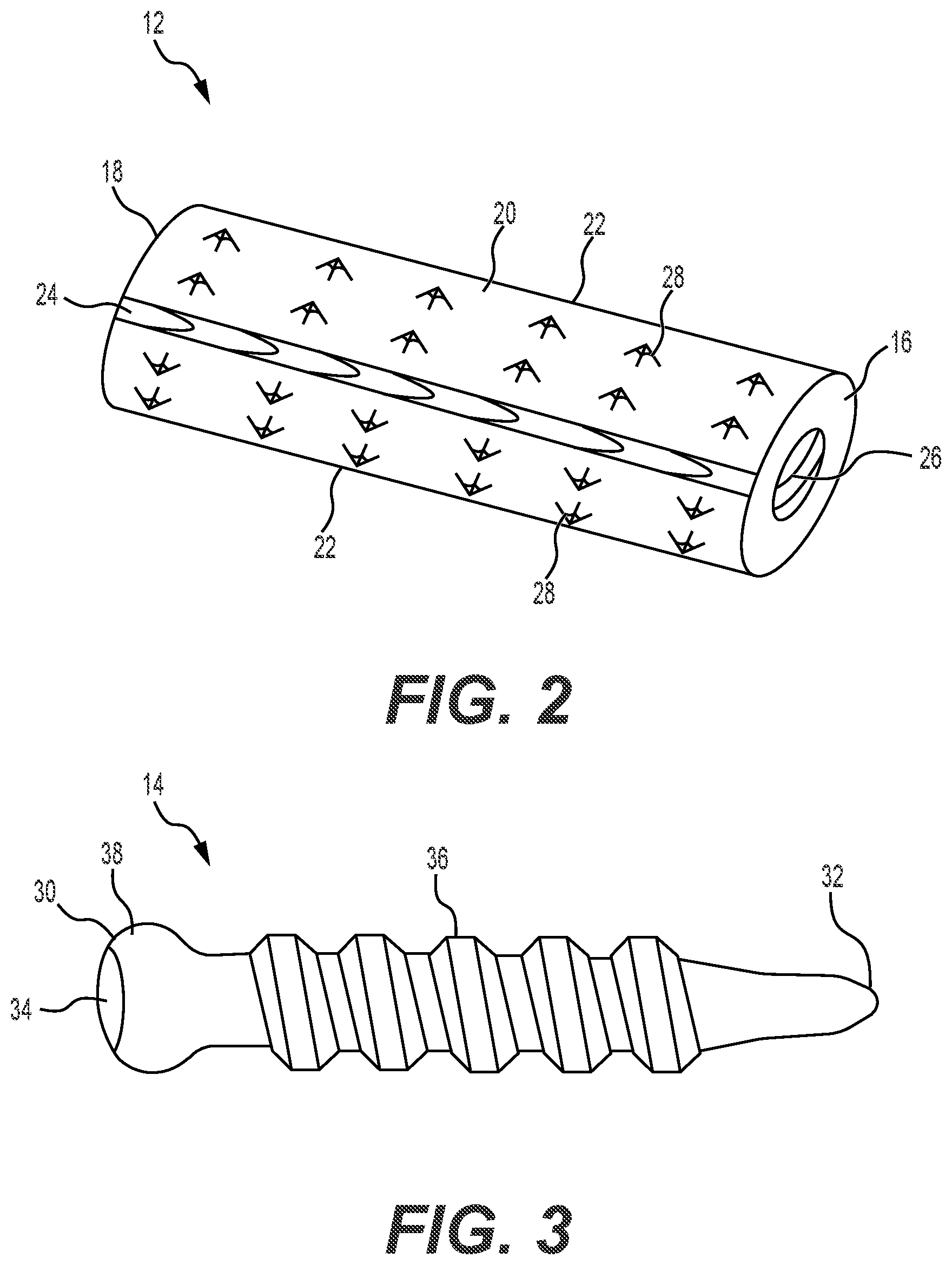 Patent US12551241 Figure 2 – Expandable bone core for pedicle screw fixation