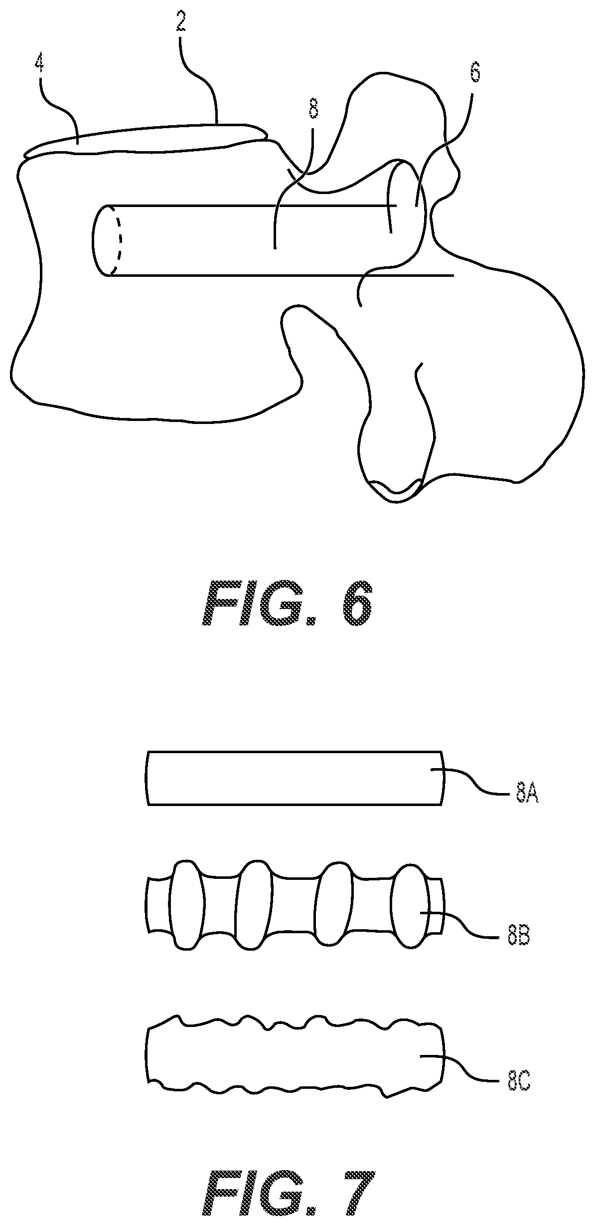 Patent US12551241 Figure 4 – Expandable bone core for pedicle screw fixation