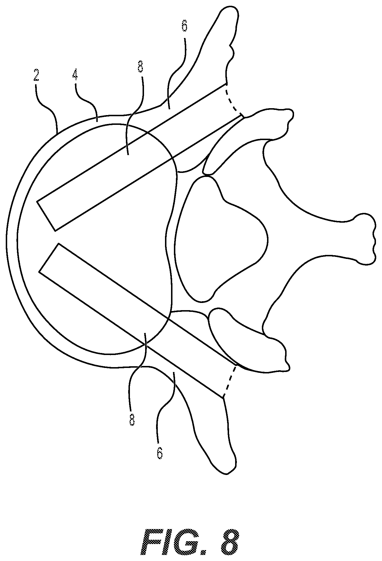 Patent US12551241 Figure 5 – Expandable bone core for pedicle screw fixation